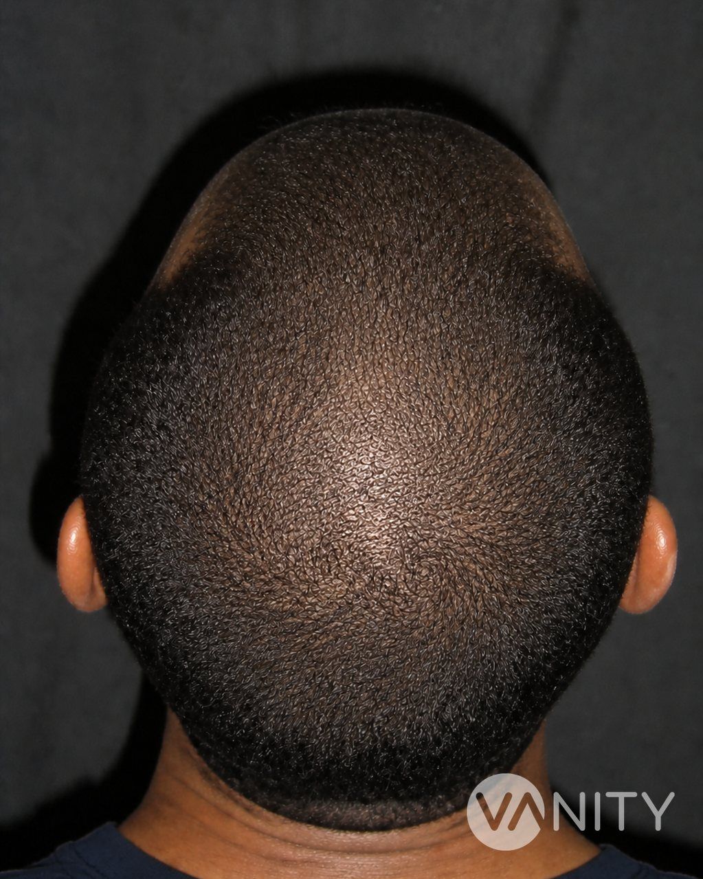 After Hair stem cell treatment — illustrative, not a real patient