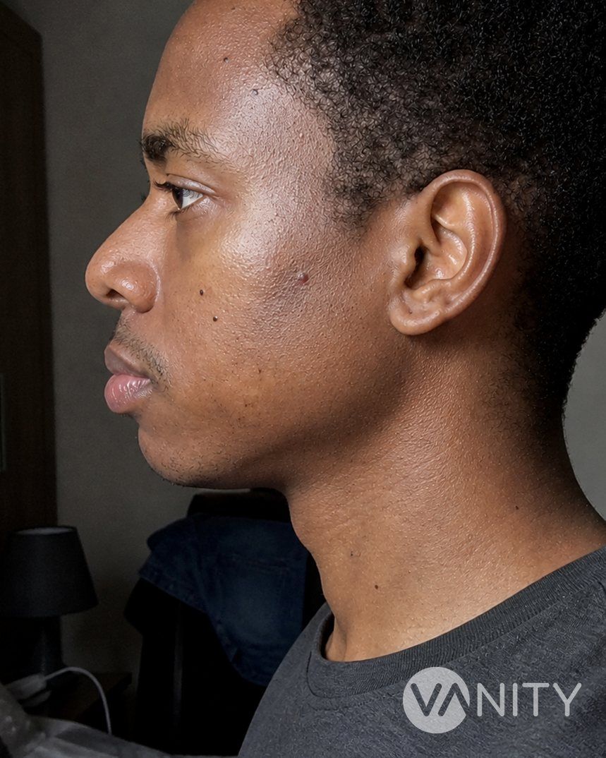 After Jawline implant — illustrative, not a real patient
