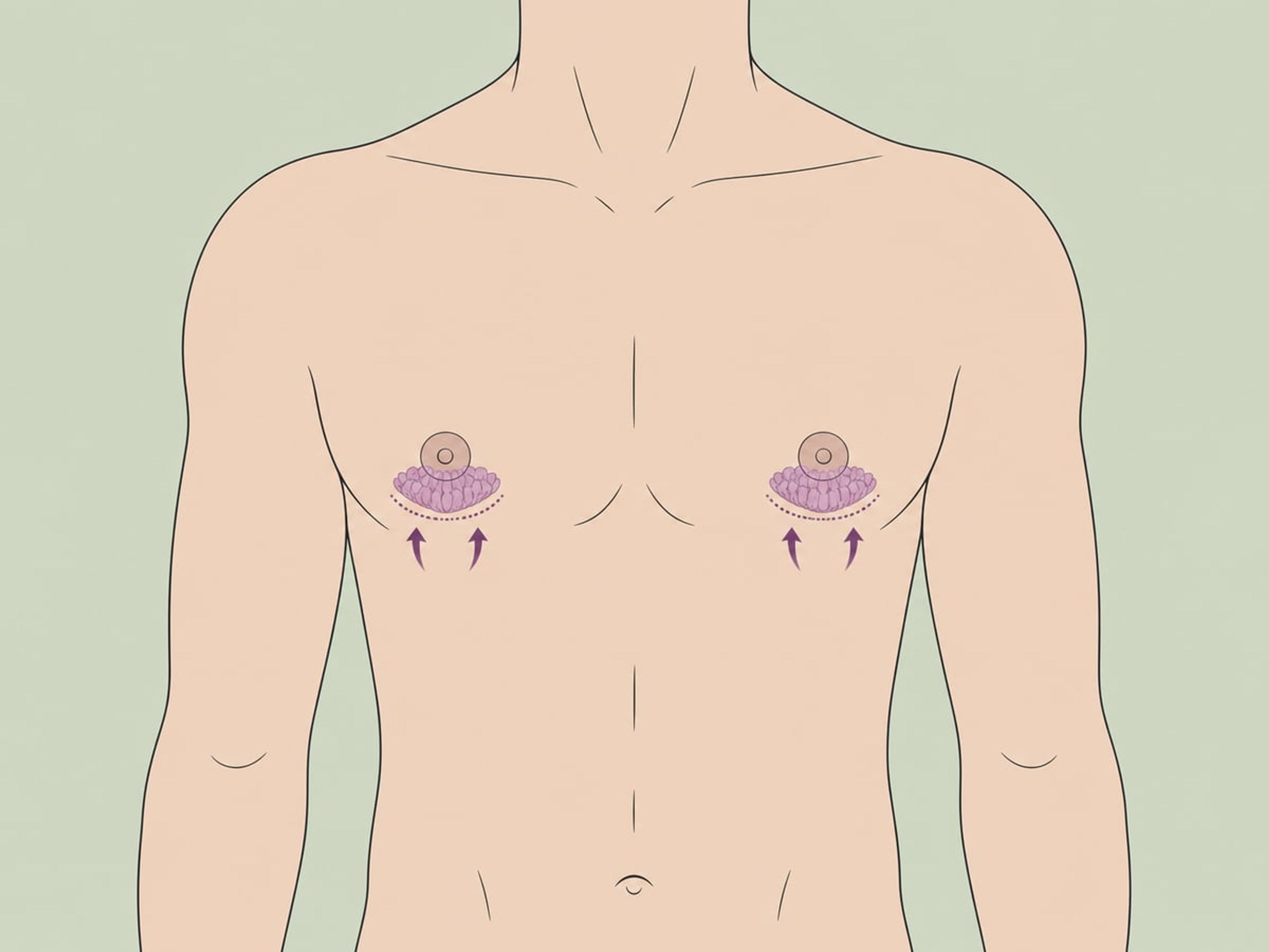 Entfernung des Drüsengewebes — illustration