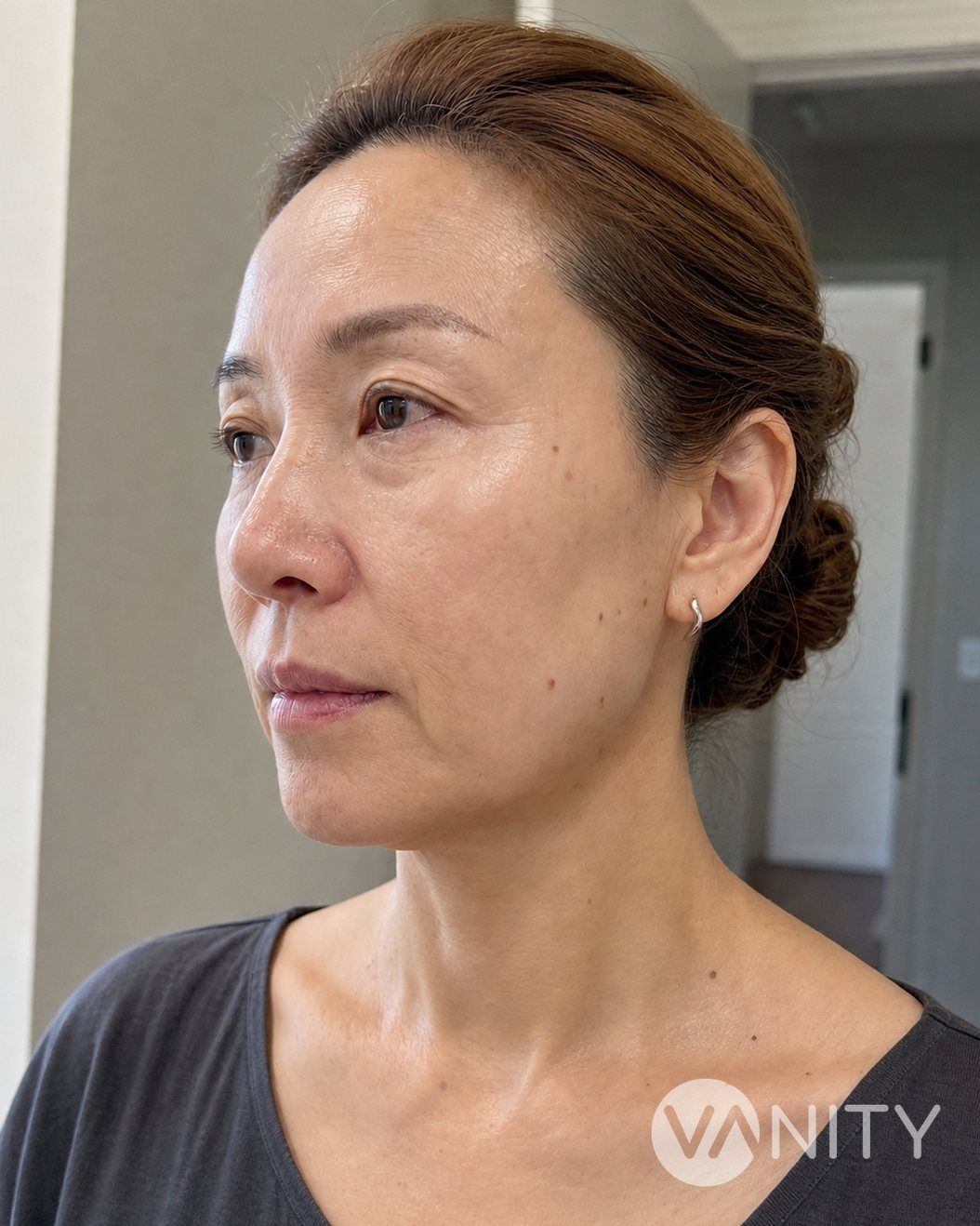 After Skin boosters — illustrative, not a real patient