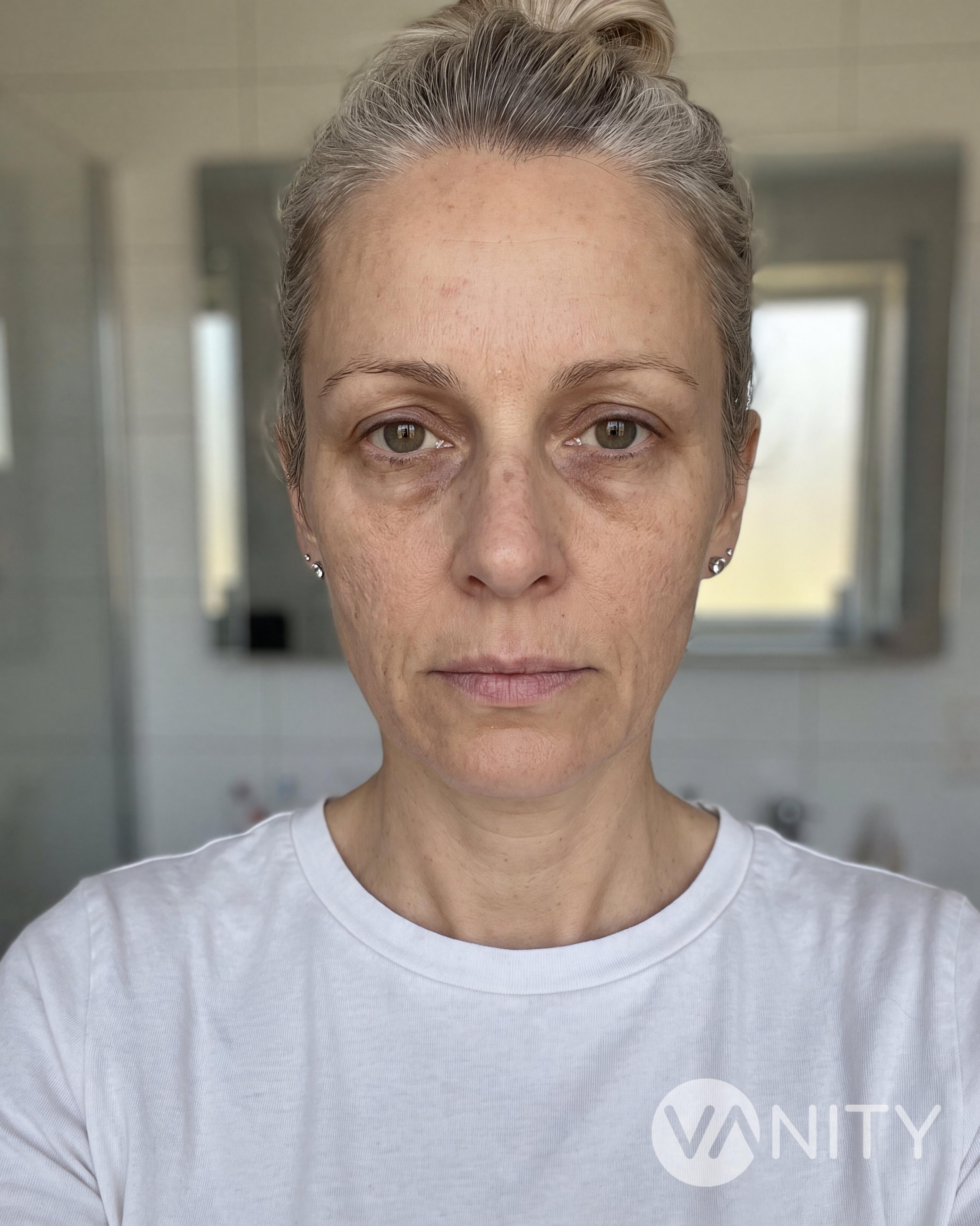 Before Mesotherapy — illustrative, not a real patient