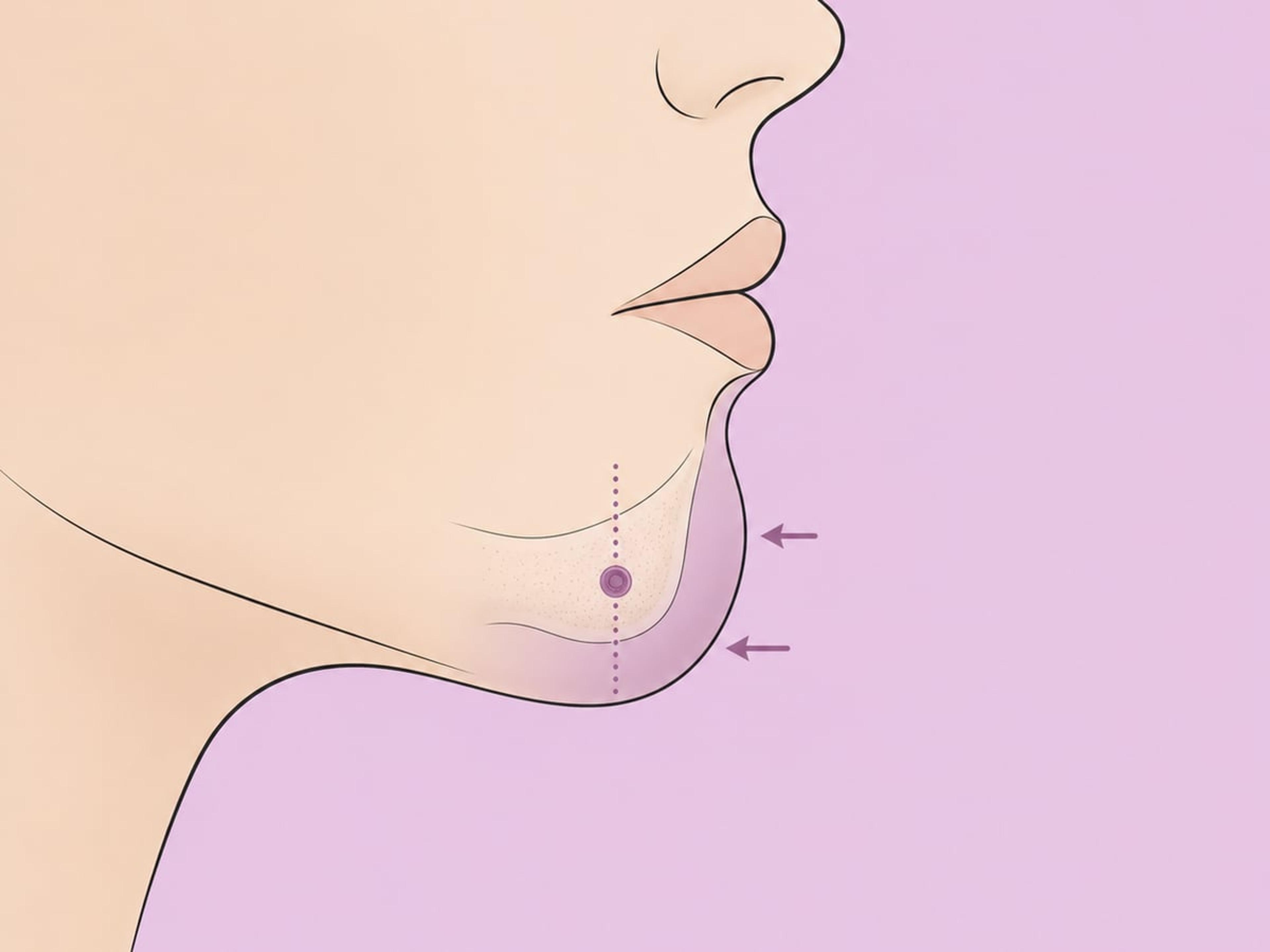 رأب الغمازات عبر الفم — illustration