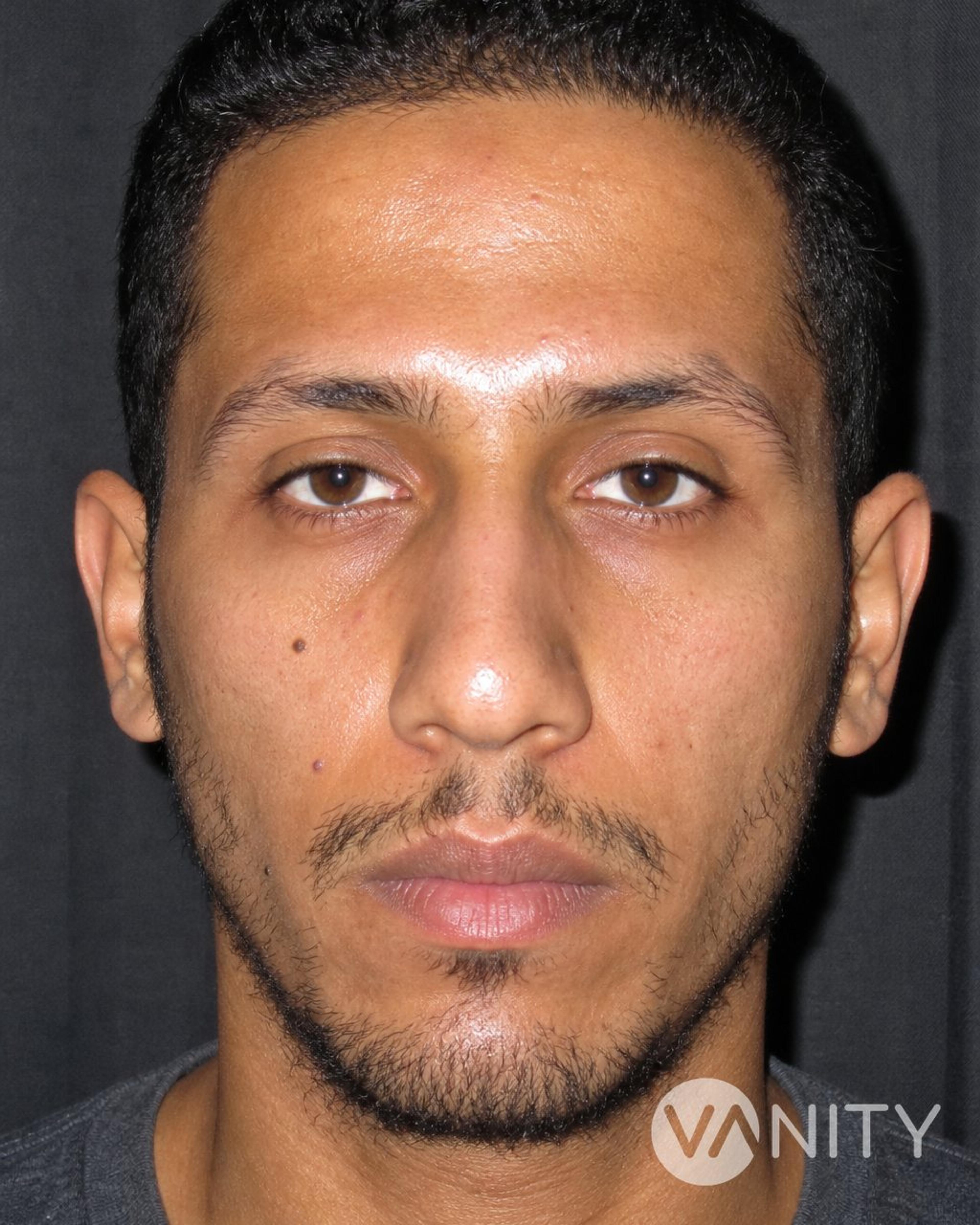 Before Beard, moustache and eyebrow transplant — illustrative, not a real patient