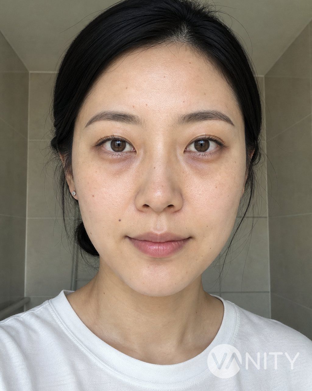Before Dark circles and under-eye treatment — illustrative, not a real patient