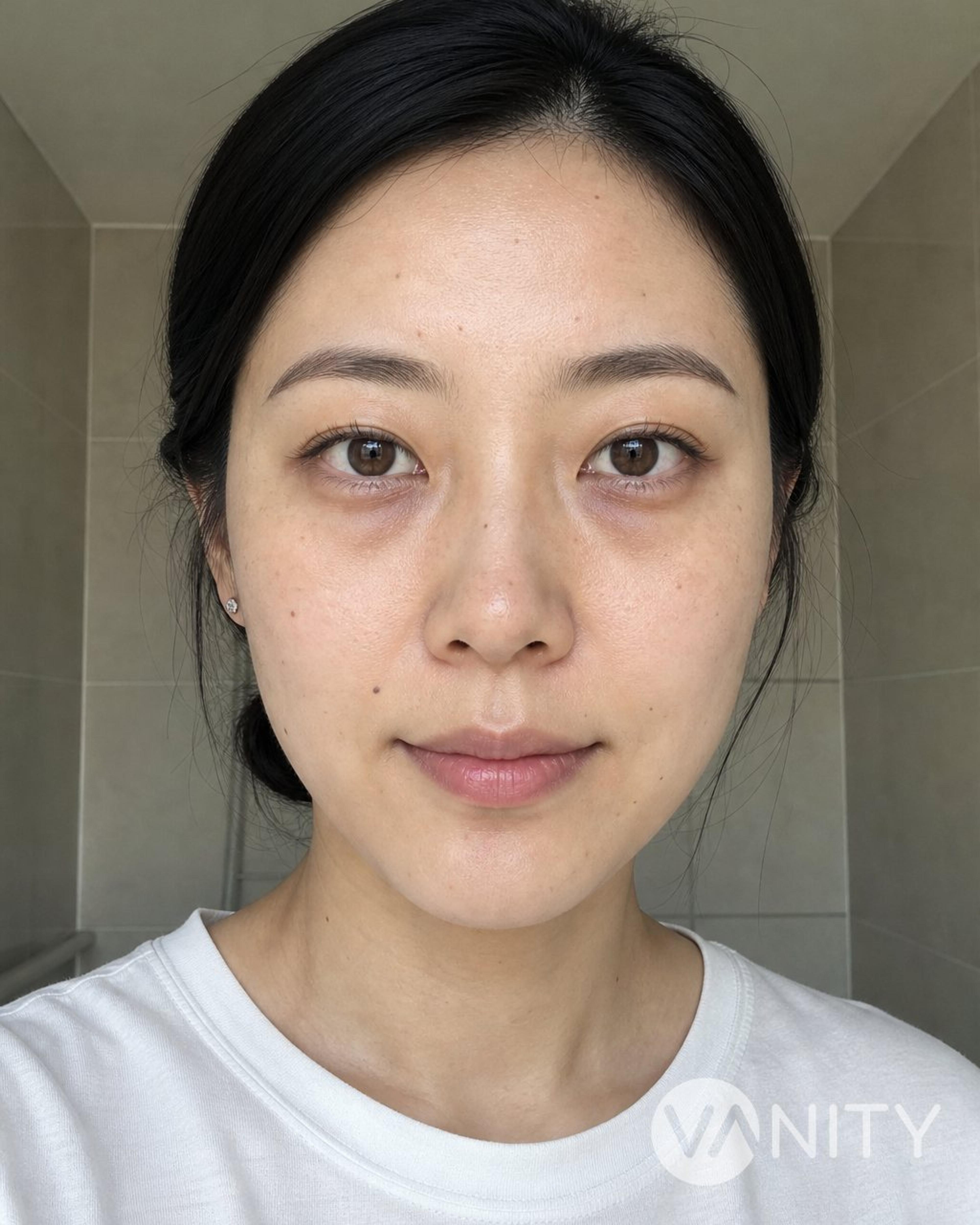 Before Dark circles and under-eye treatment — illustrative, not a real patient