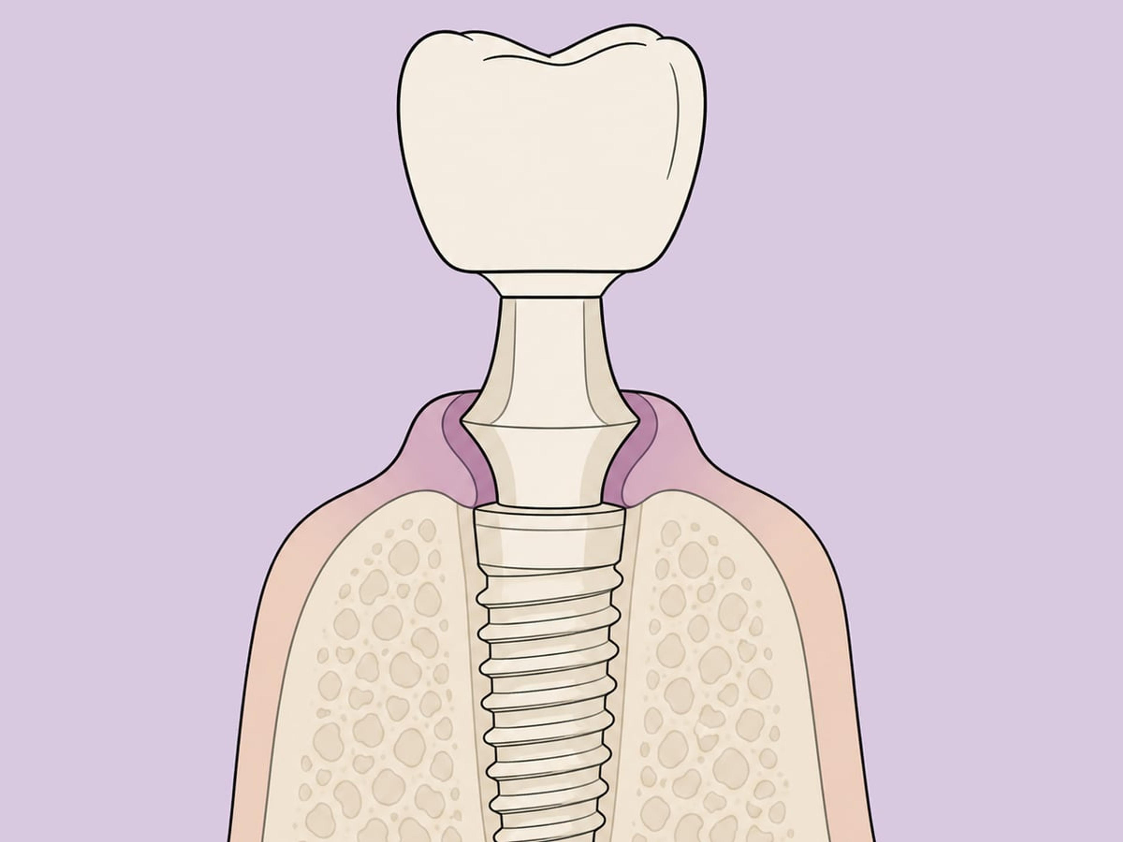 وضع على مرحلة واحدة مع تحميل فوري أو مبكر — illustration