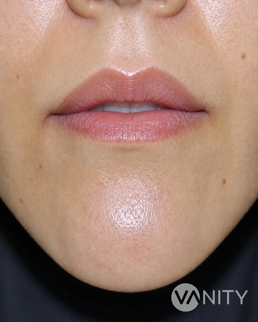 After Lip lift — illustrative, not a real patient