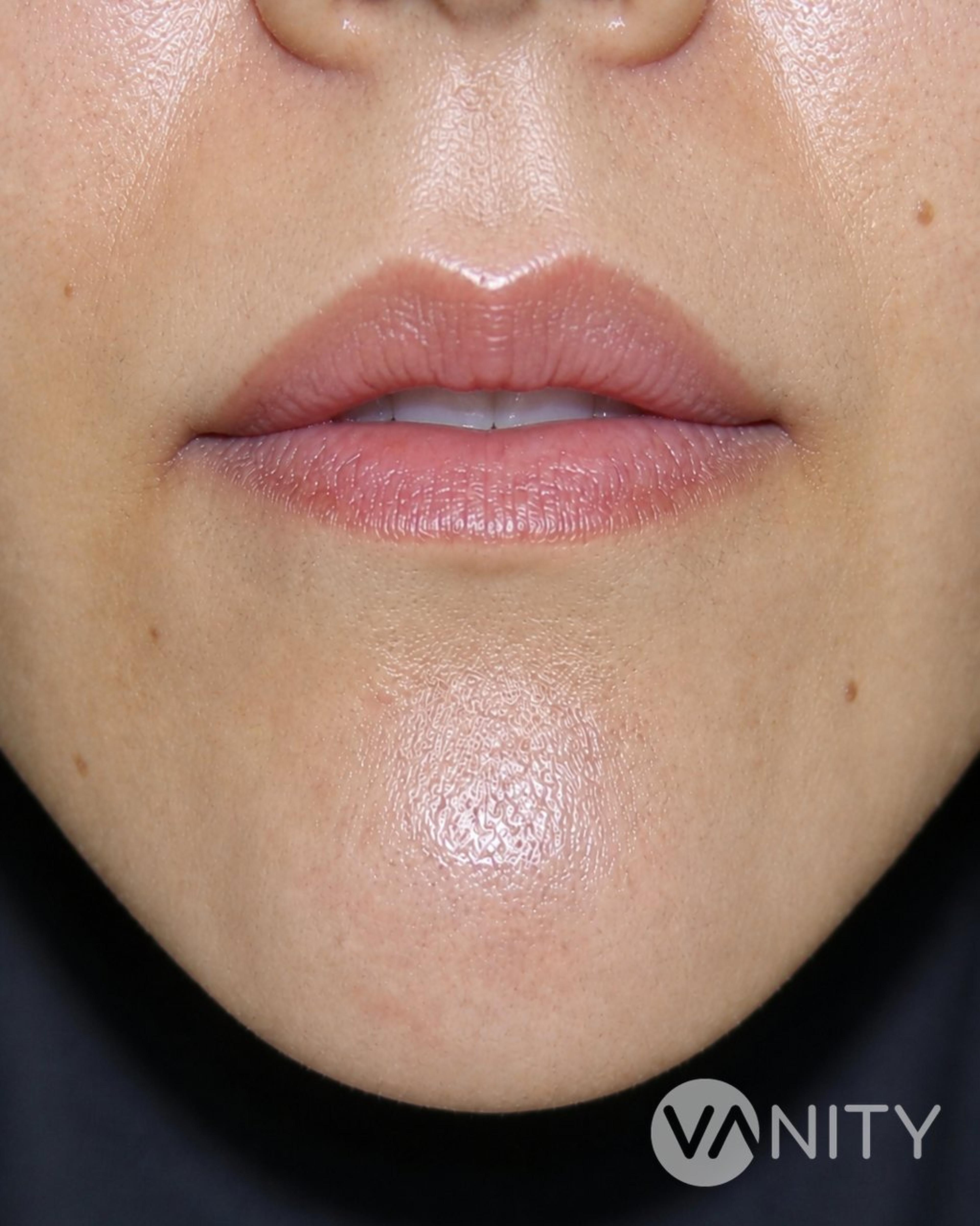 After Lip lift — illustrative, not a real patient