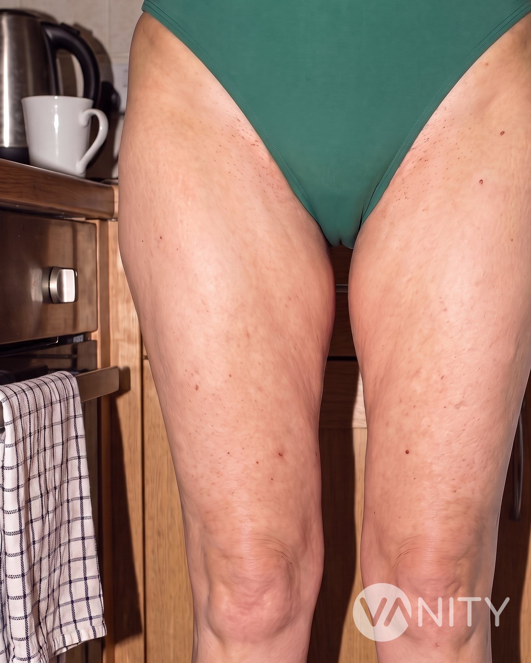 After Thigh lift — illustrative, not a real patient