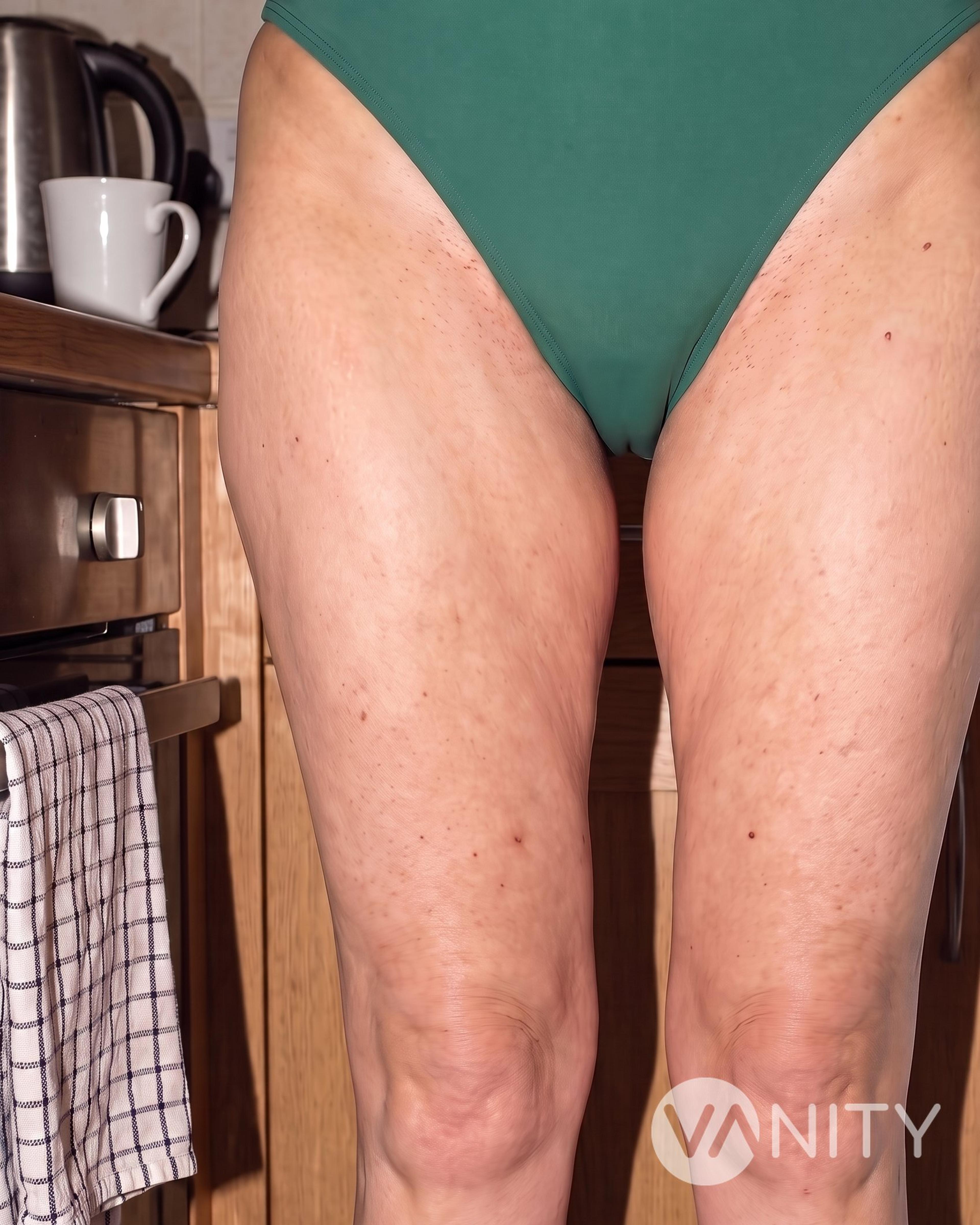 After Thigh lift — illustrative, not a real patient