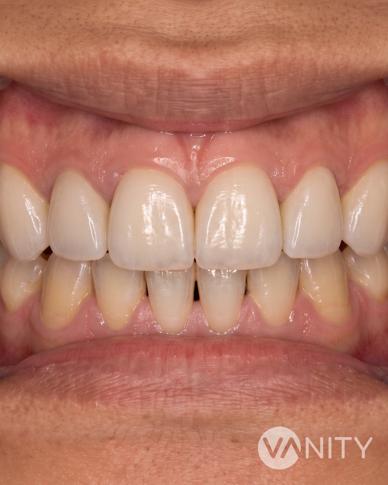 After Dental veneers — illustrative, not a real patient