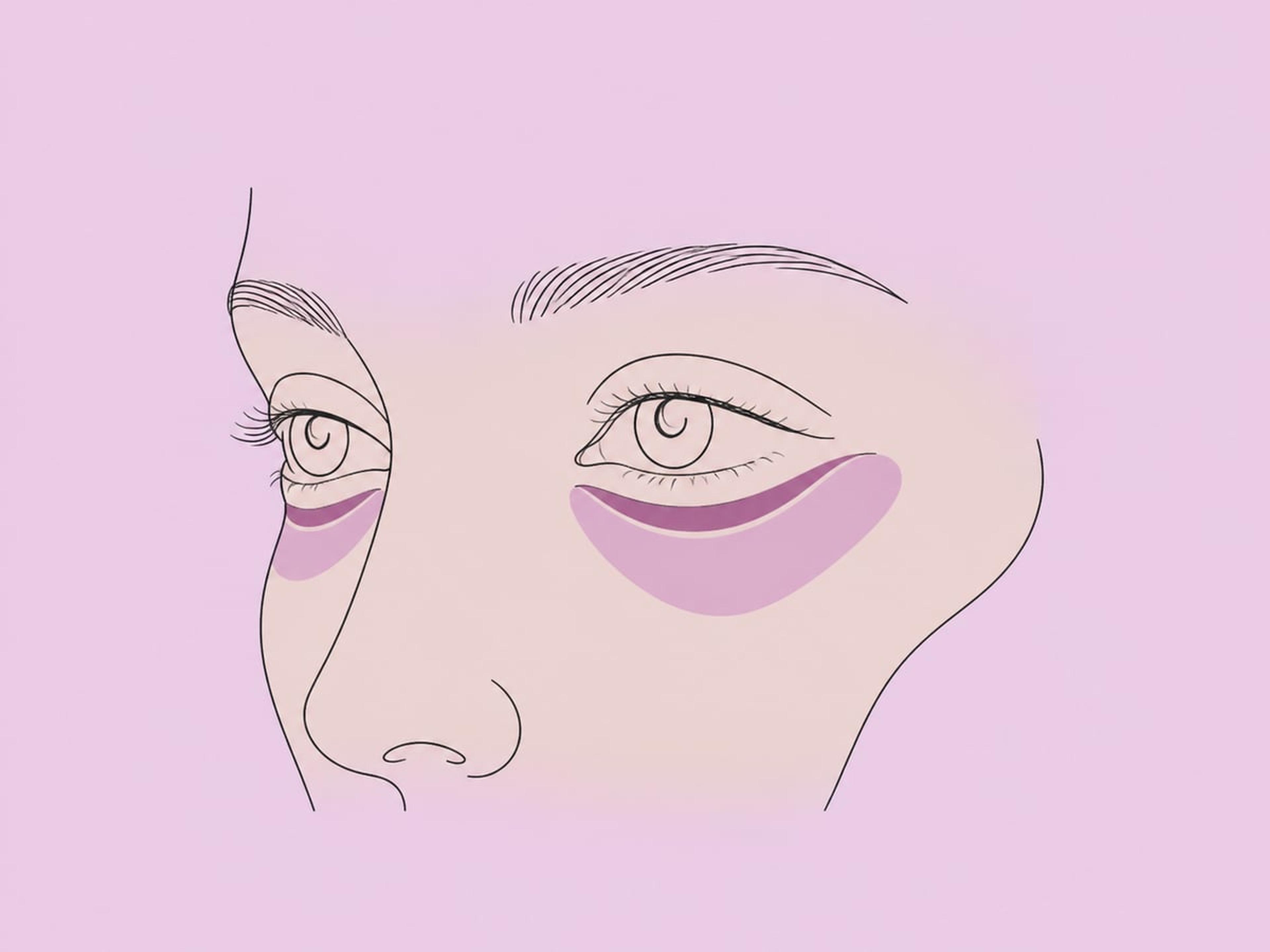 Gesichtseigenfettinjektion bei hohlen oder eingesunkenen Augen — illustration