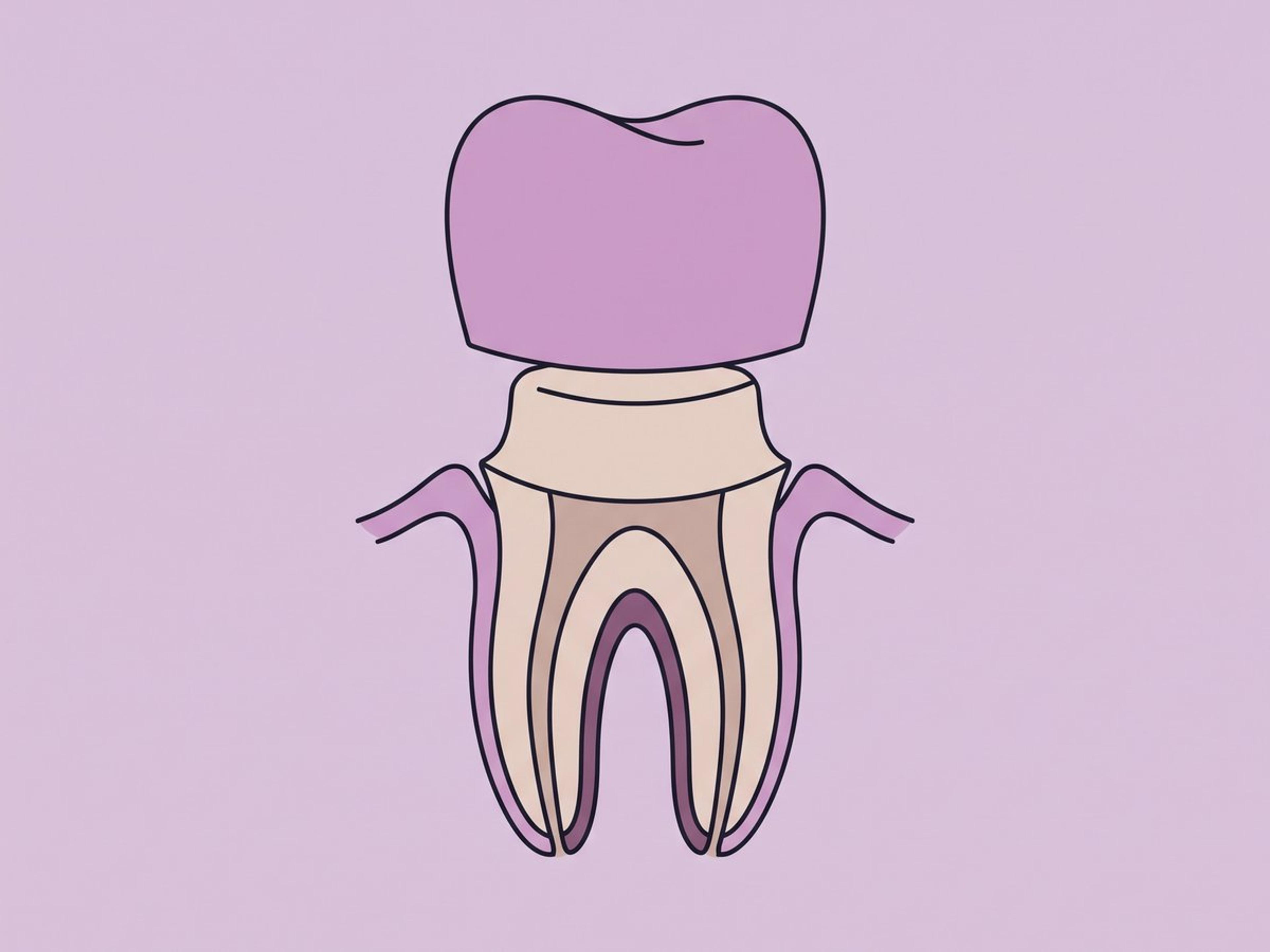 تاج زركونيا أحادي الكتلة — illustration