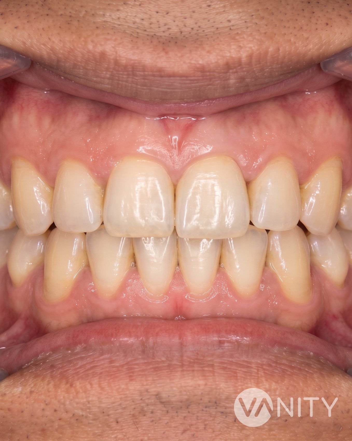 After Dental implants — illustrative, not a real patient