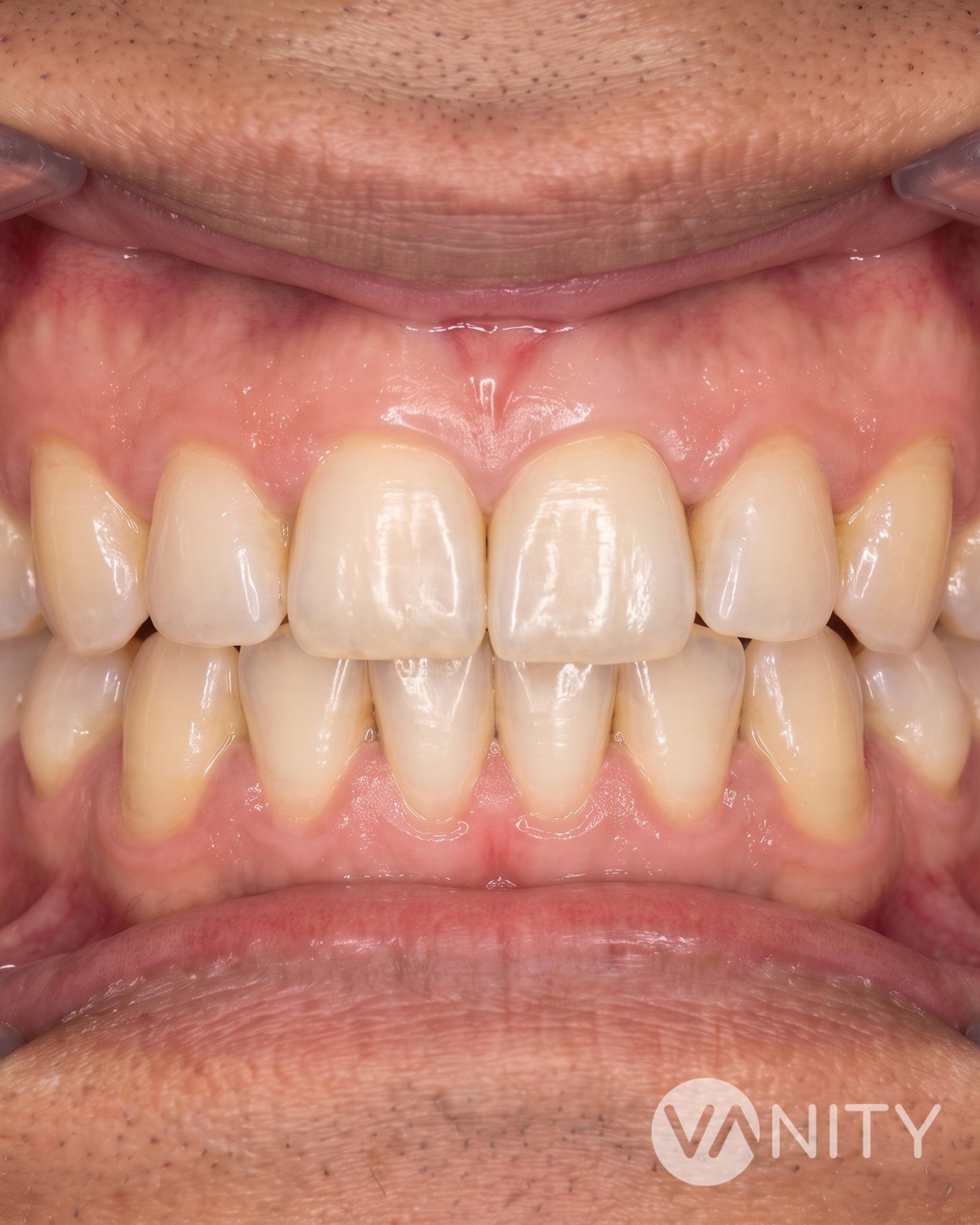 After Dental implants — illustrative, not a real patient