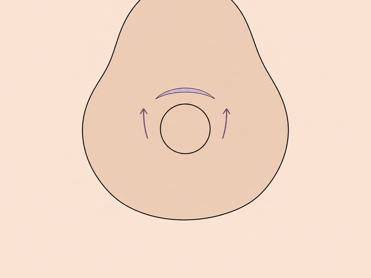 Halbmondstraffung — illustration