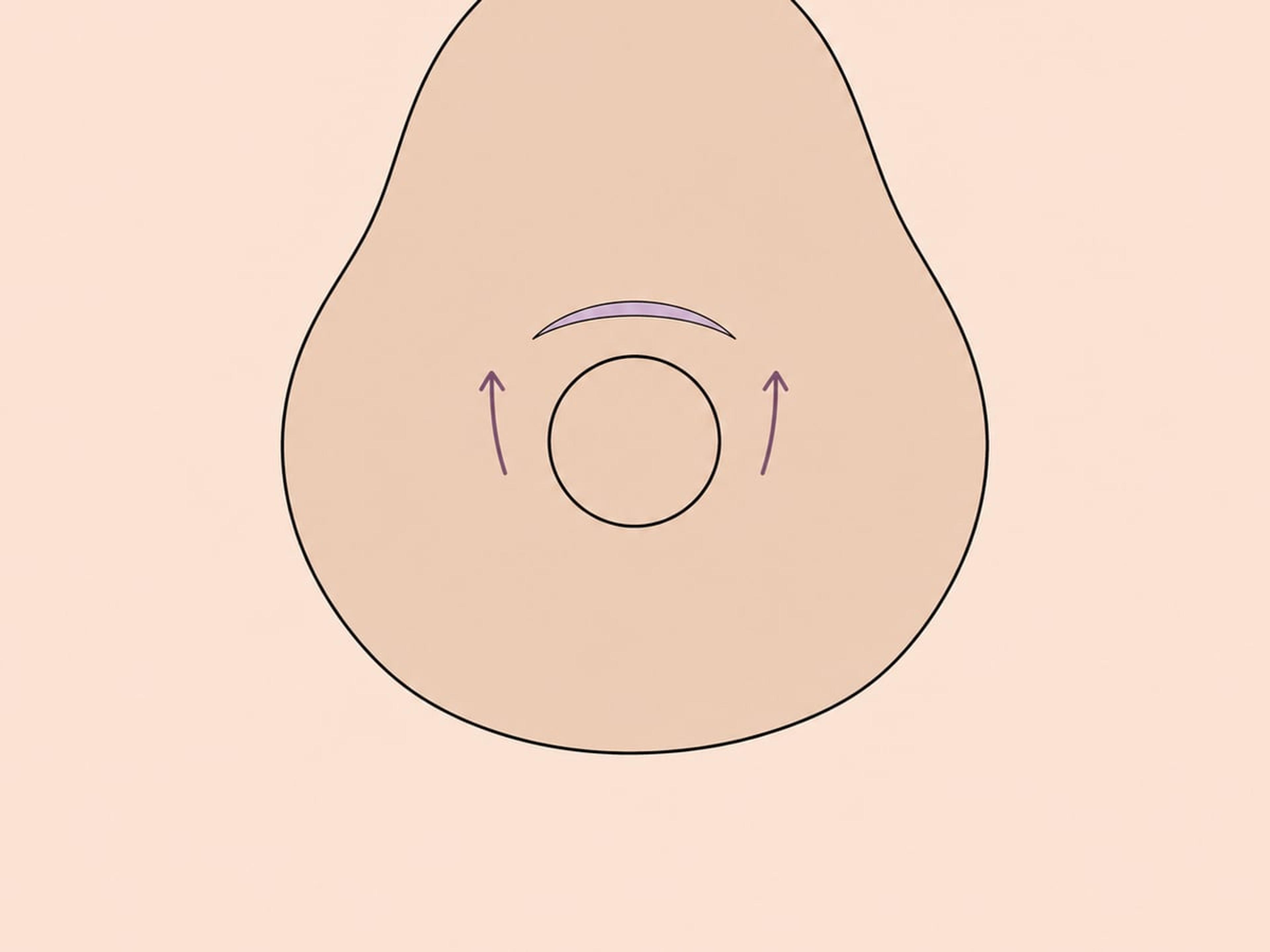 Halbmondstraffung — illustration