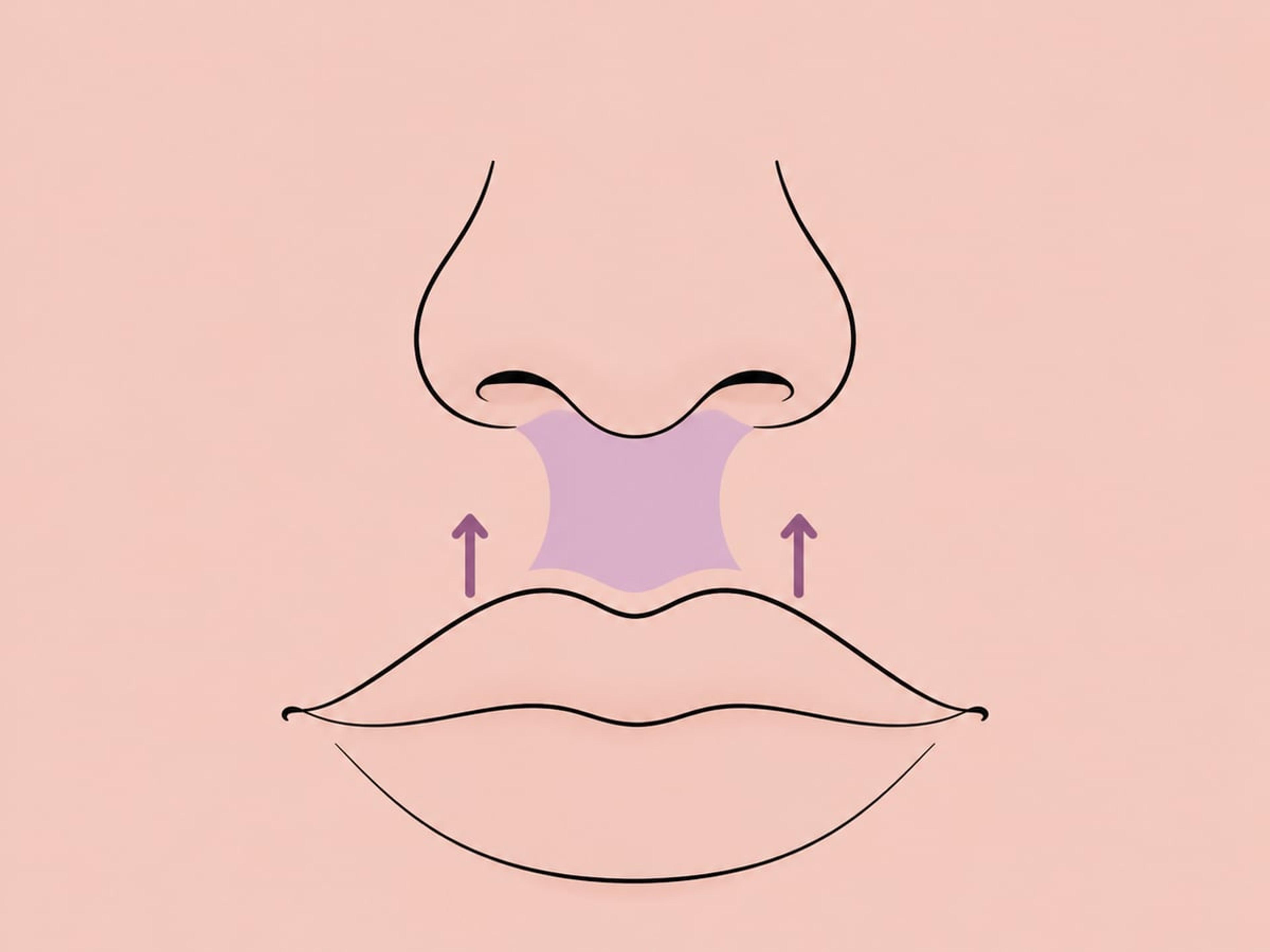 Lifting labial — illustration