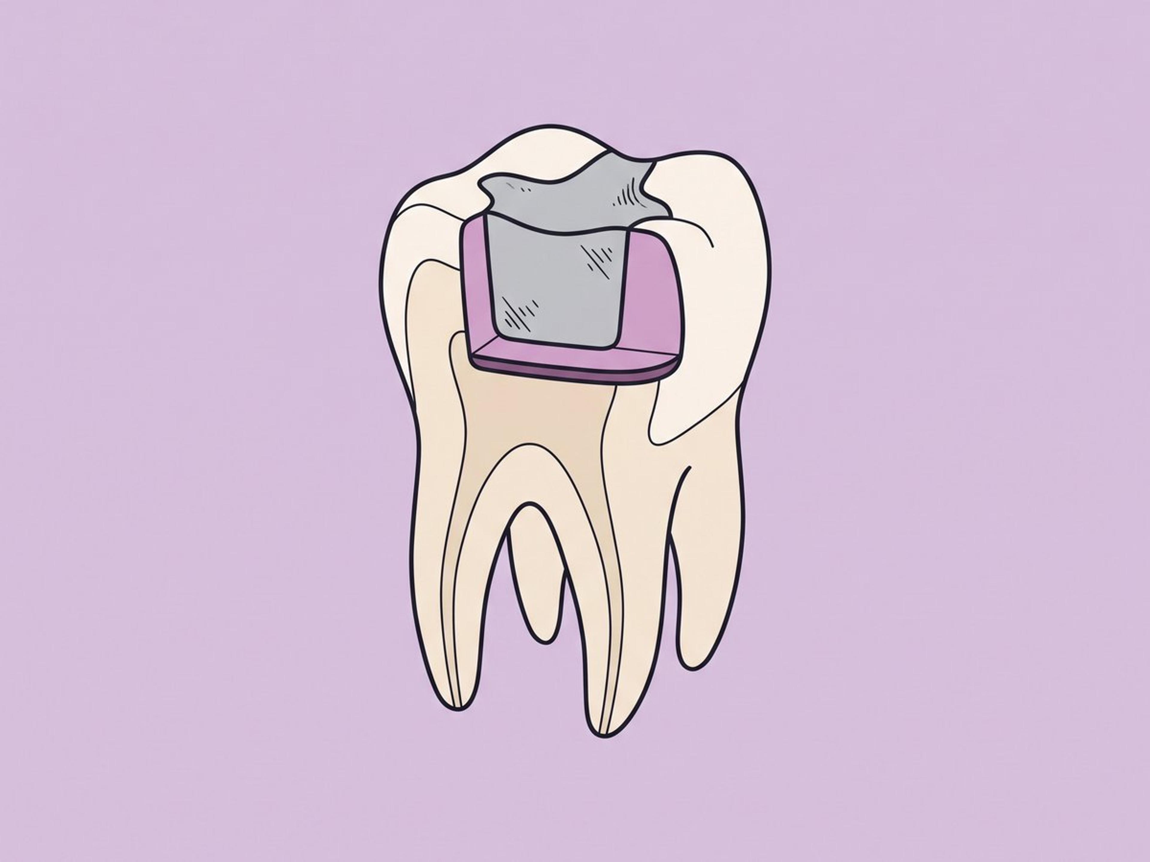 الملغم السني — بلون فضي، يوضع مباشرة — illustration