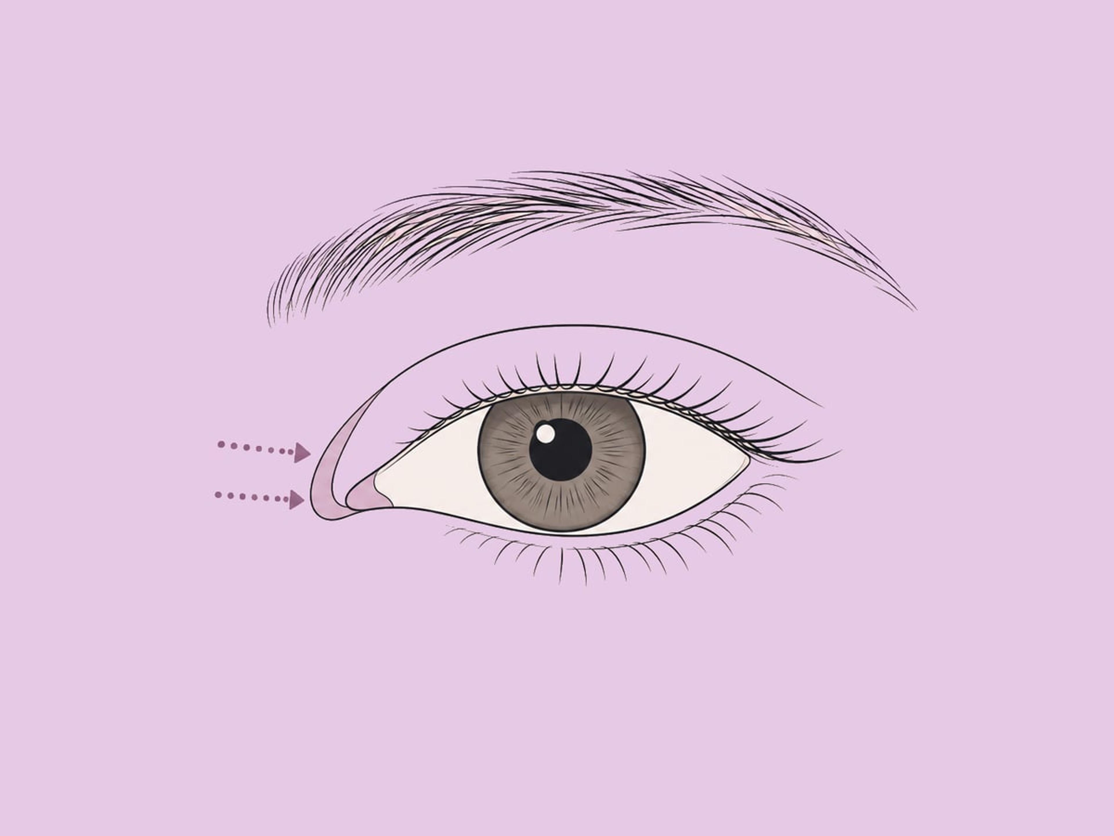 Epikanthoplastik (kombiniert) — illustration