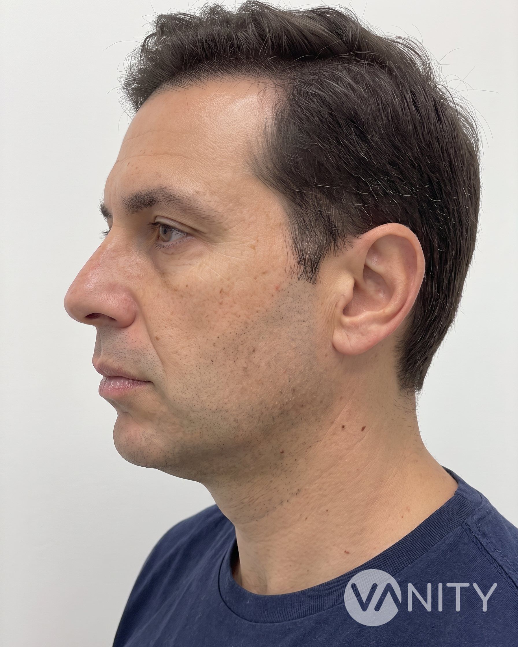 After Dermal fillers — illustrative, not a real patient