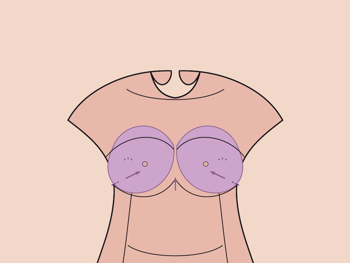 Verkleinerung nur durch Fettabsaugung — illustration