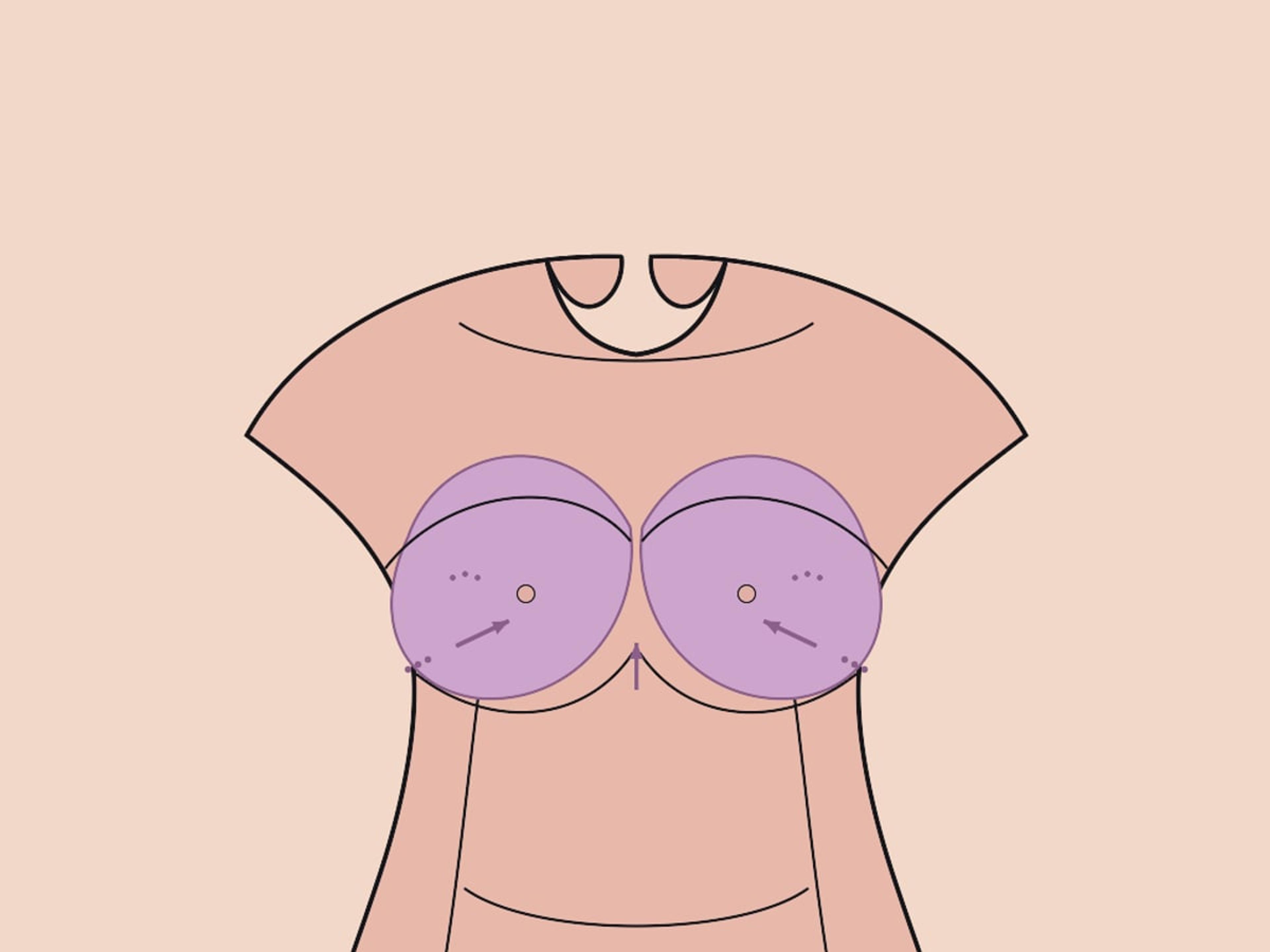 Verkleinerung nur durch Fettabsaugung — illustration