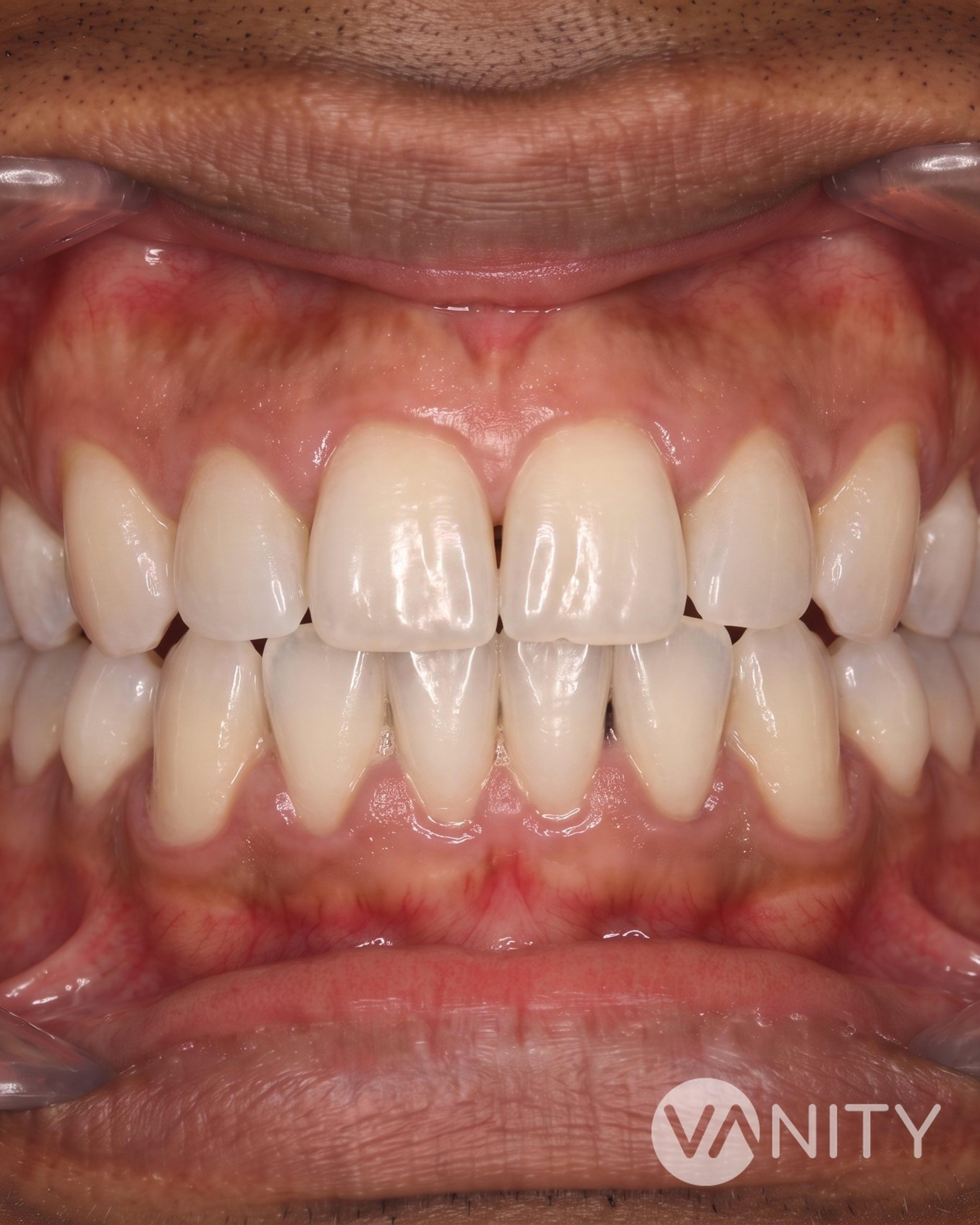 After Teeth whitening — illustrative, not a real patient