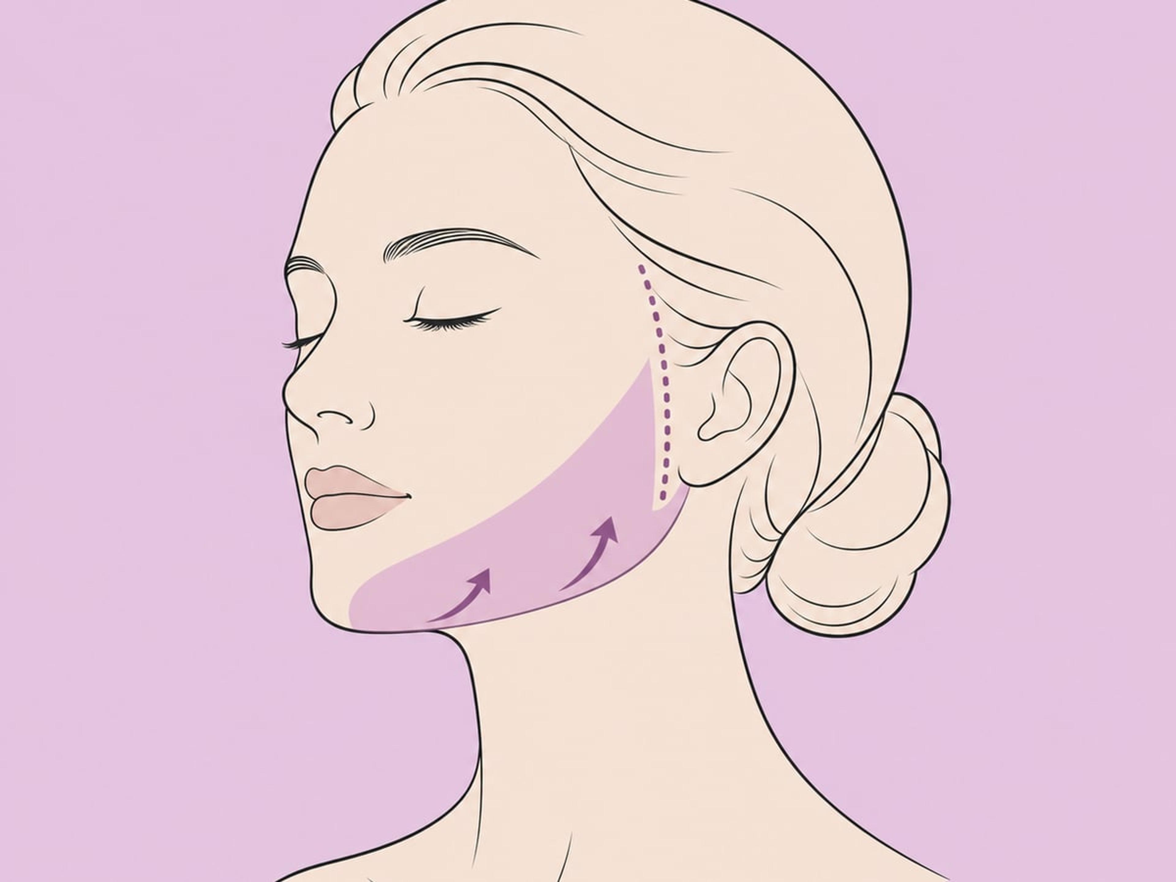 Mini-Facelift — illustration