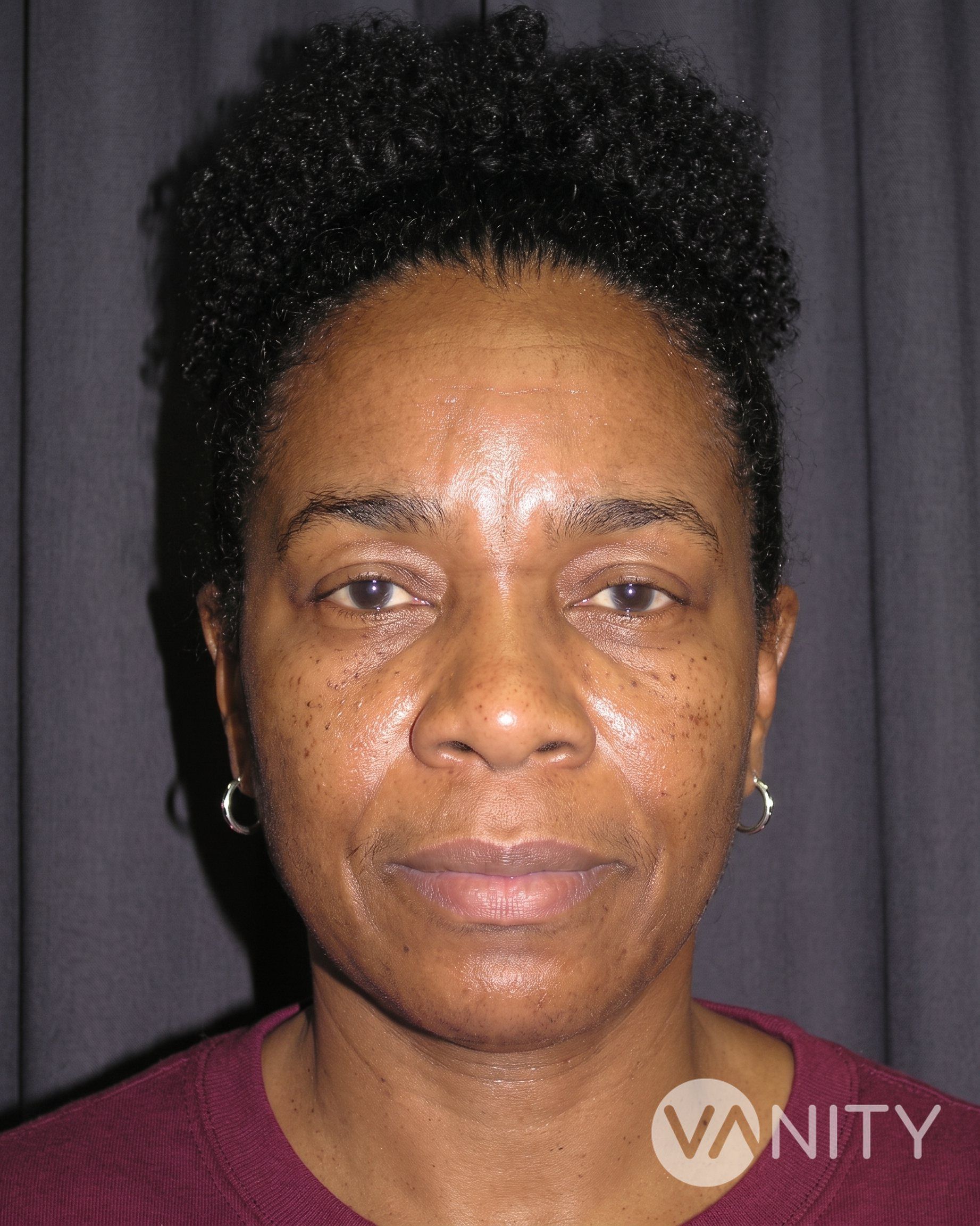 After Brow lift — illustrative, not a real patient
