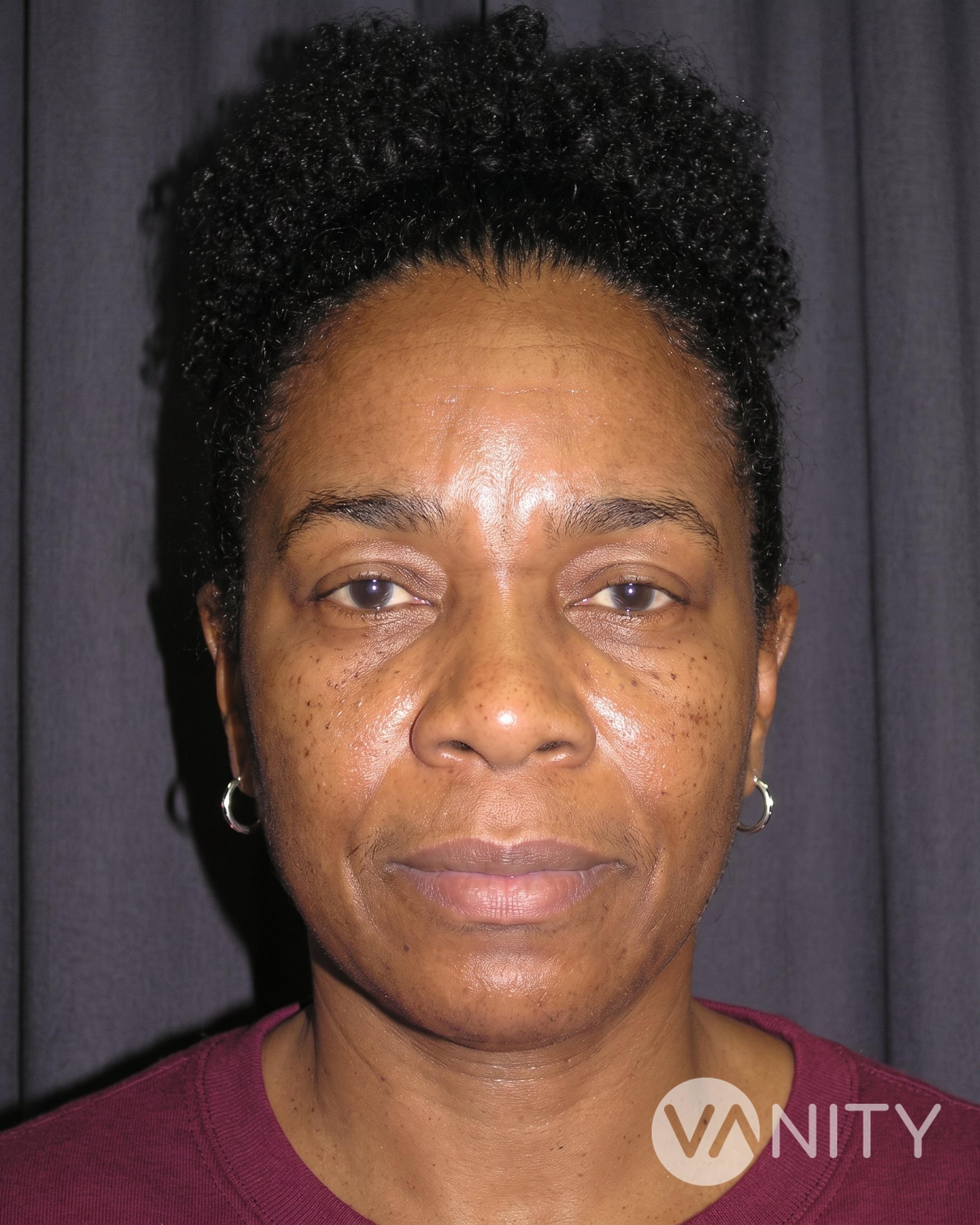 After Brow lift — illustrative, not a real patient