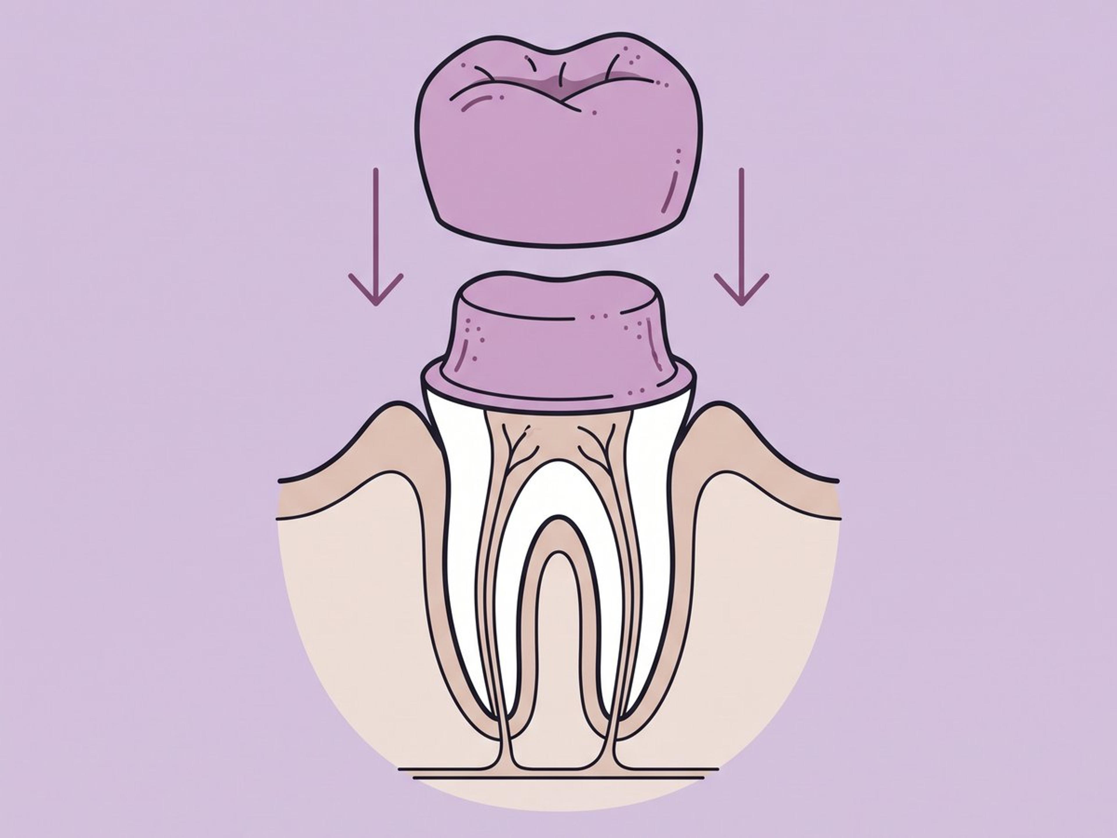 تاج CAD/CAM في العيادة في اليوم نفسه — illustration