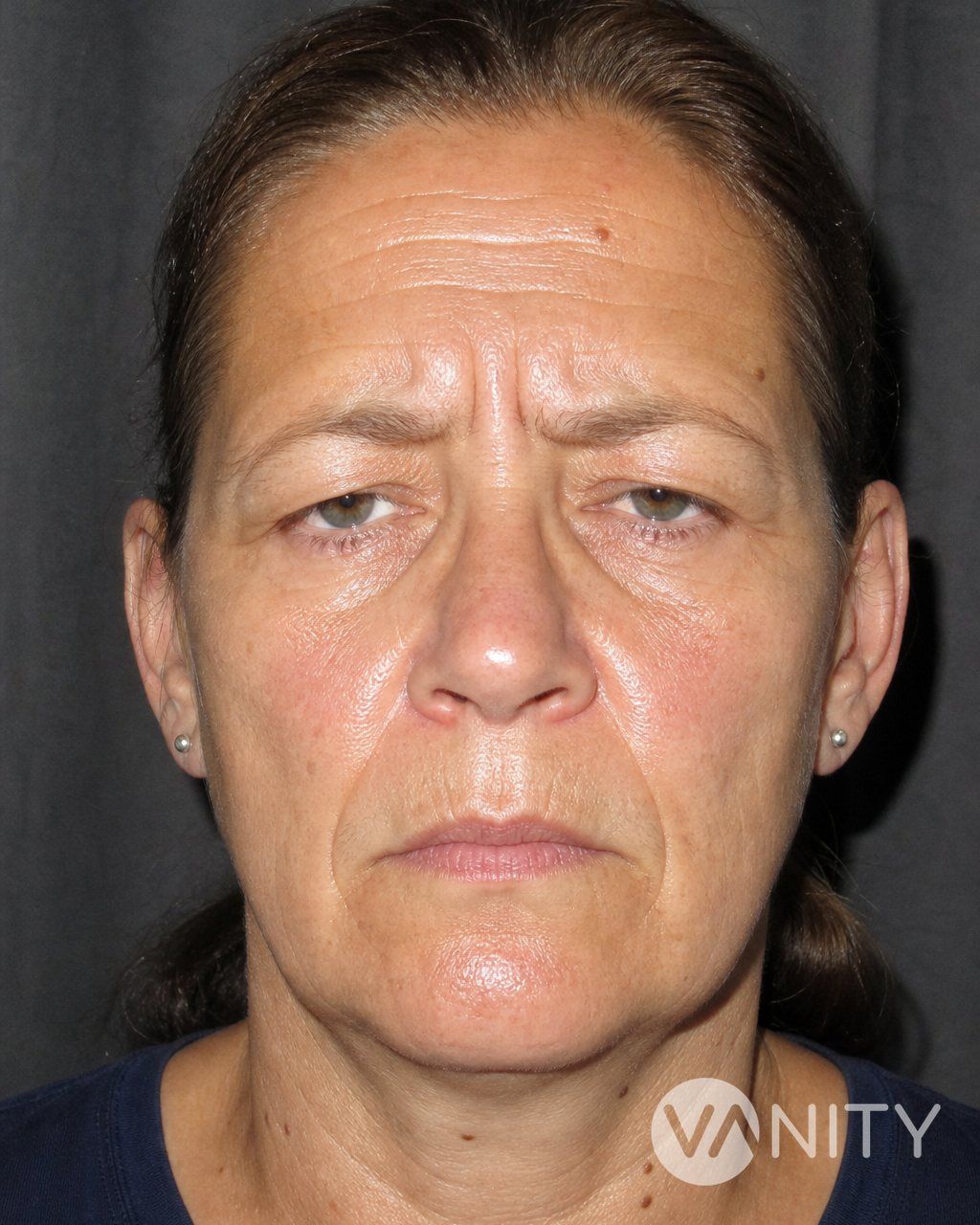 Before Forehead lift — illustrative, not a real patient