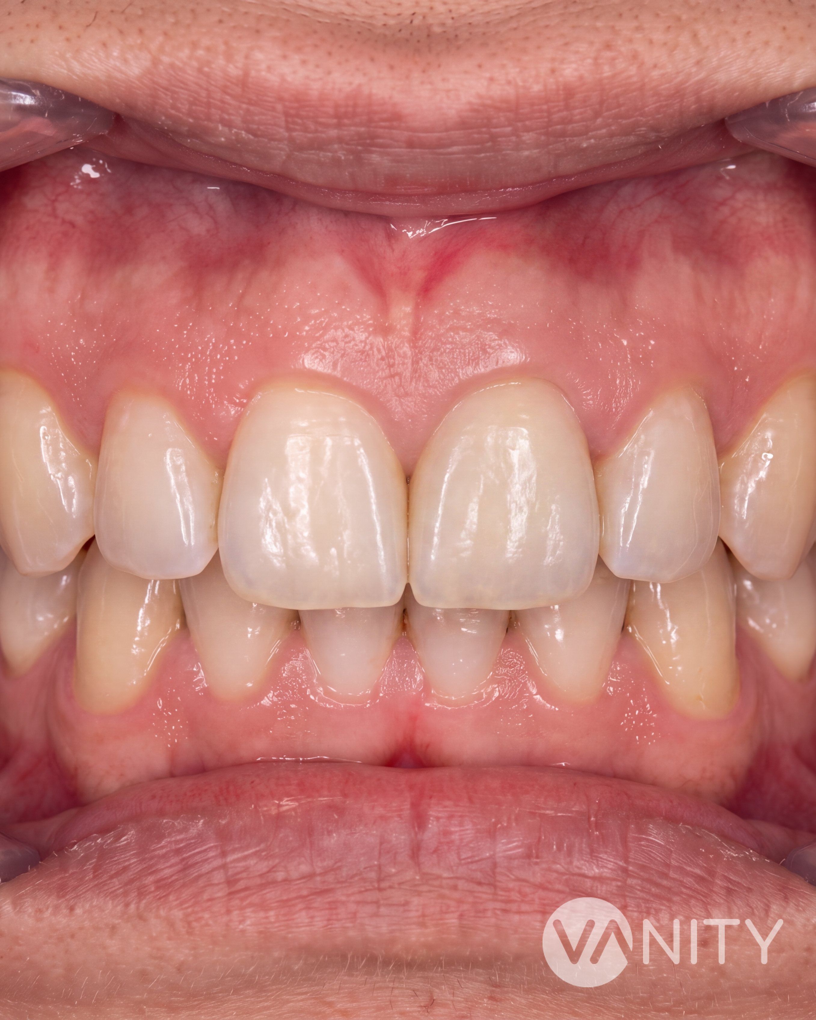 After Root canal treatment — illustrative, not a real patient