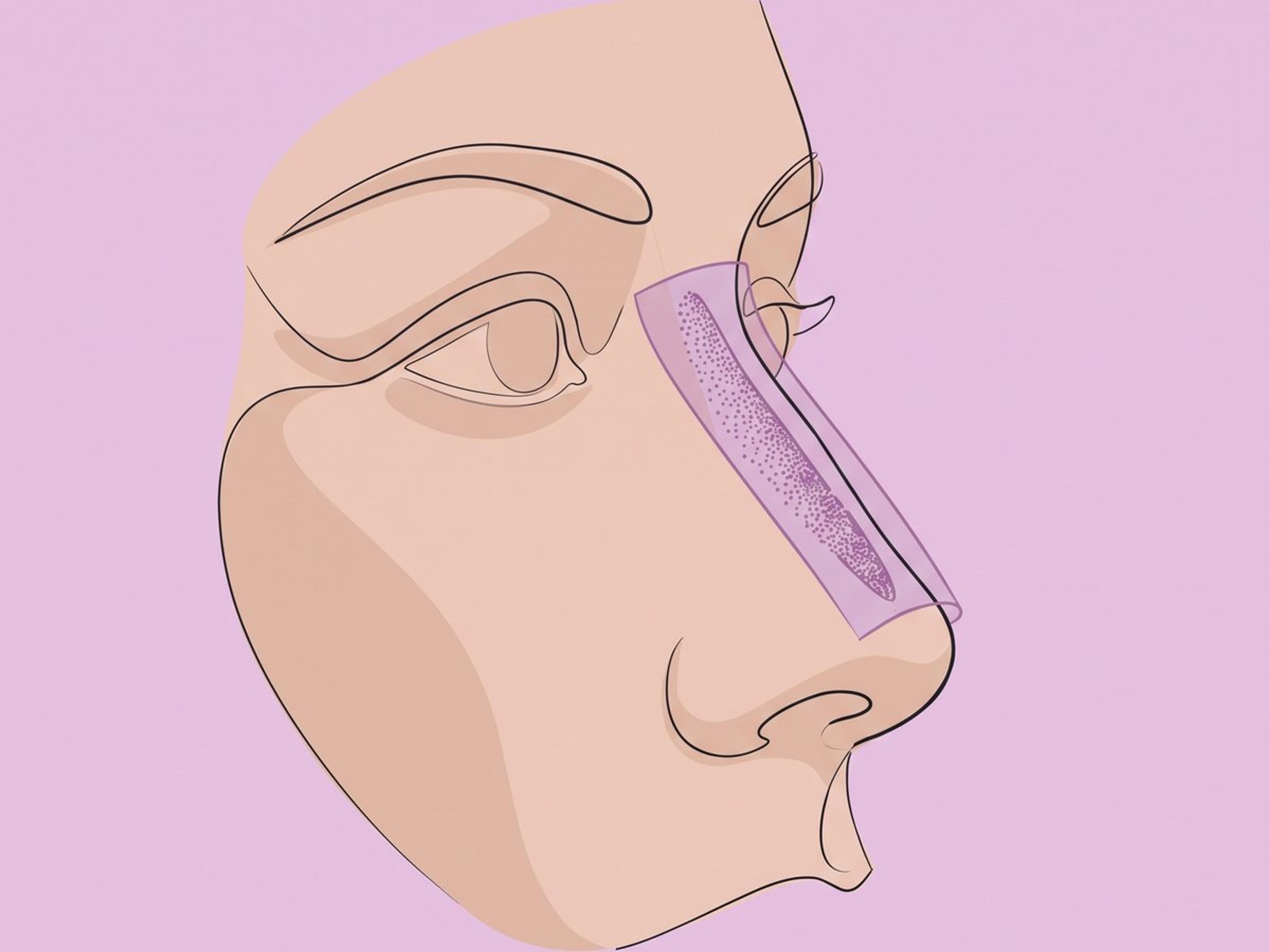 Gewürfelter Knorpel mit Faszie zur Kaschierung des Nasenrückens — illustration