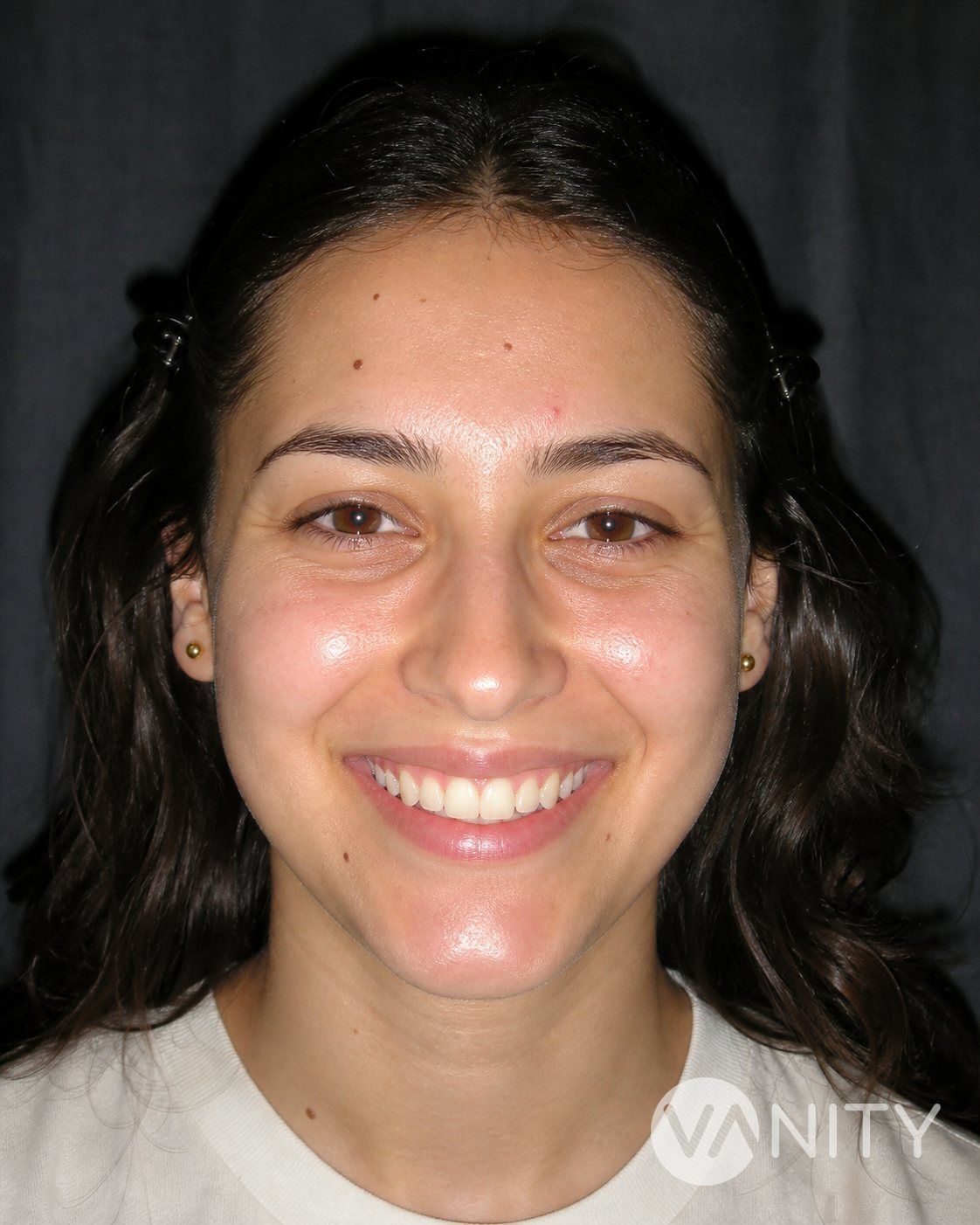 Before Dimple surgery — illustrative, not a real patient