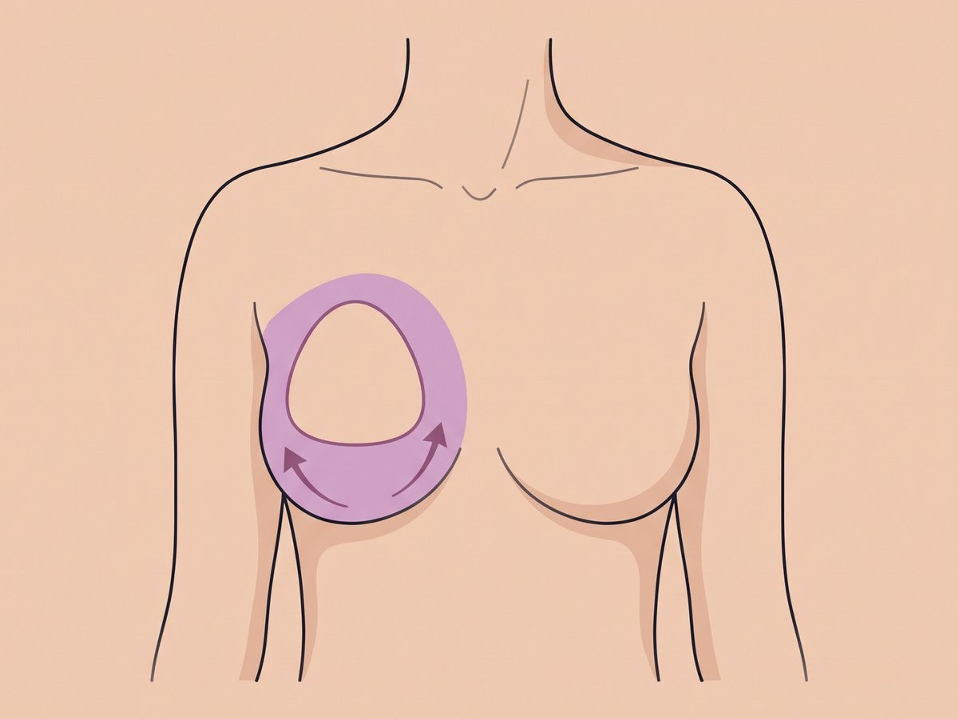 Entfernung mit Austausch, Straffung oder Eigenfetttransplantation — illustration