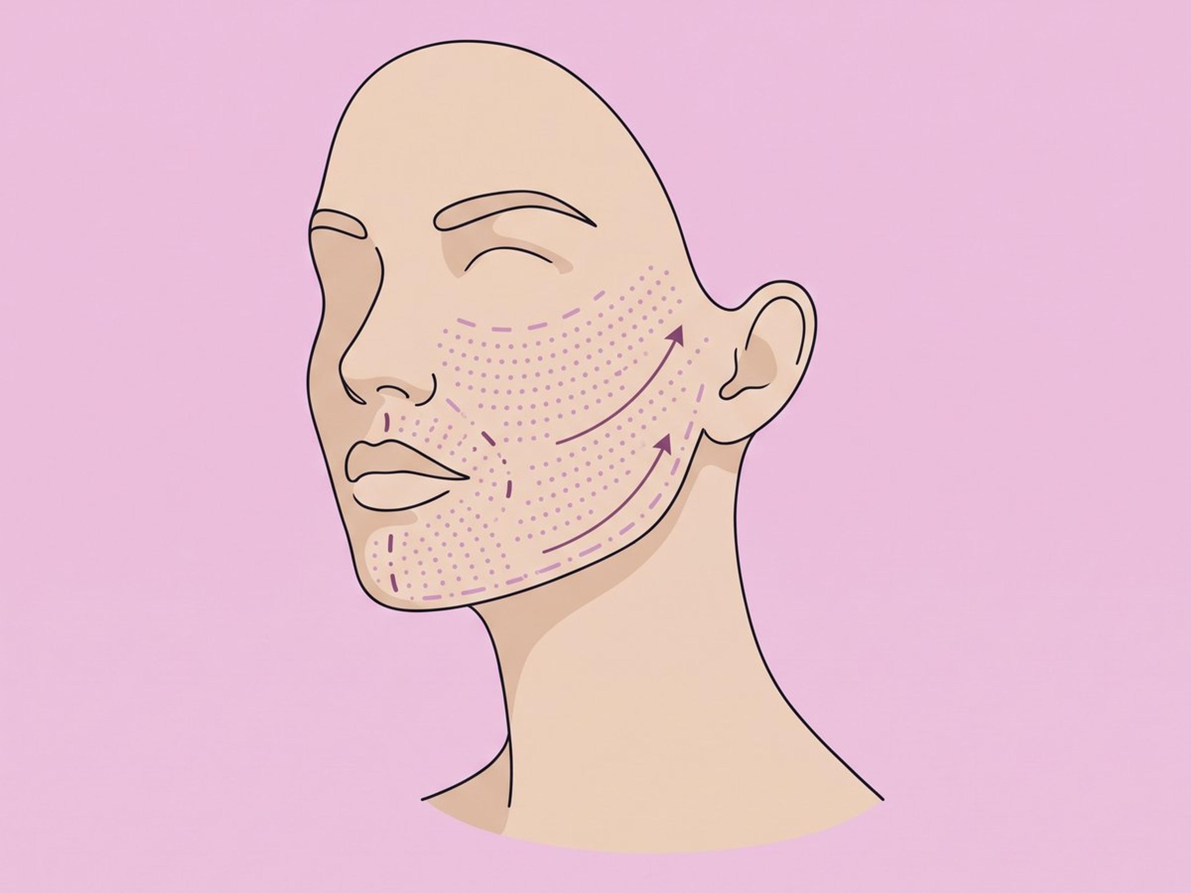 Facelift mit fraktionierter CO2-Laser-Hauterneuerung — illustration