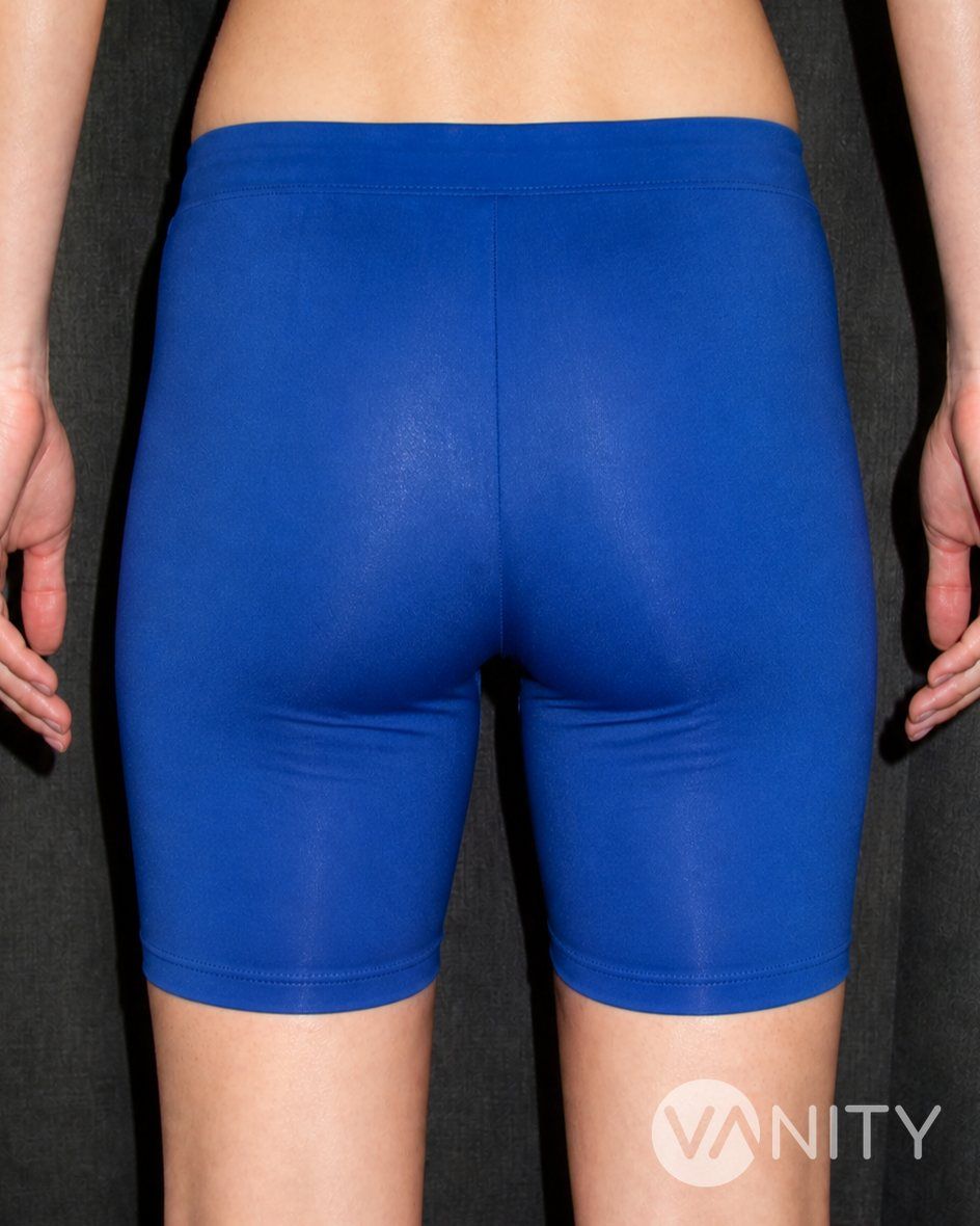 Before Buttock implants — illustrative, not a real patient