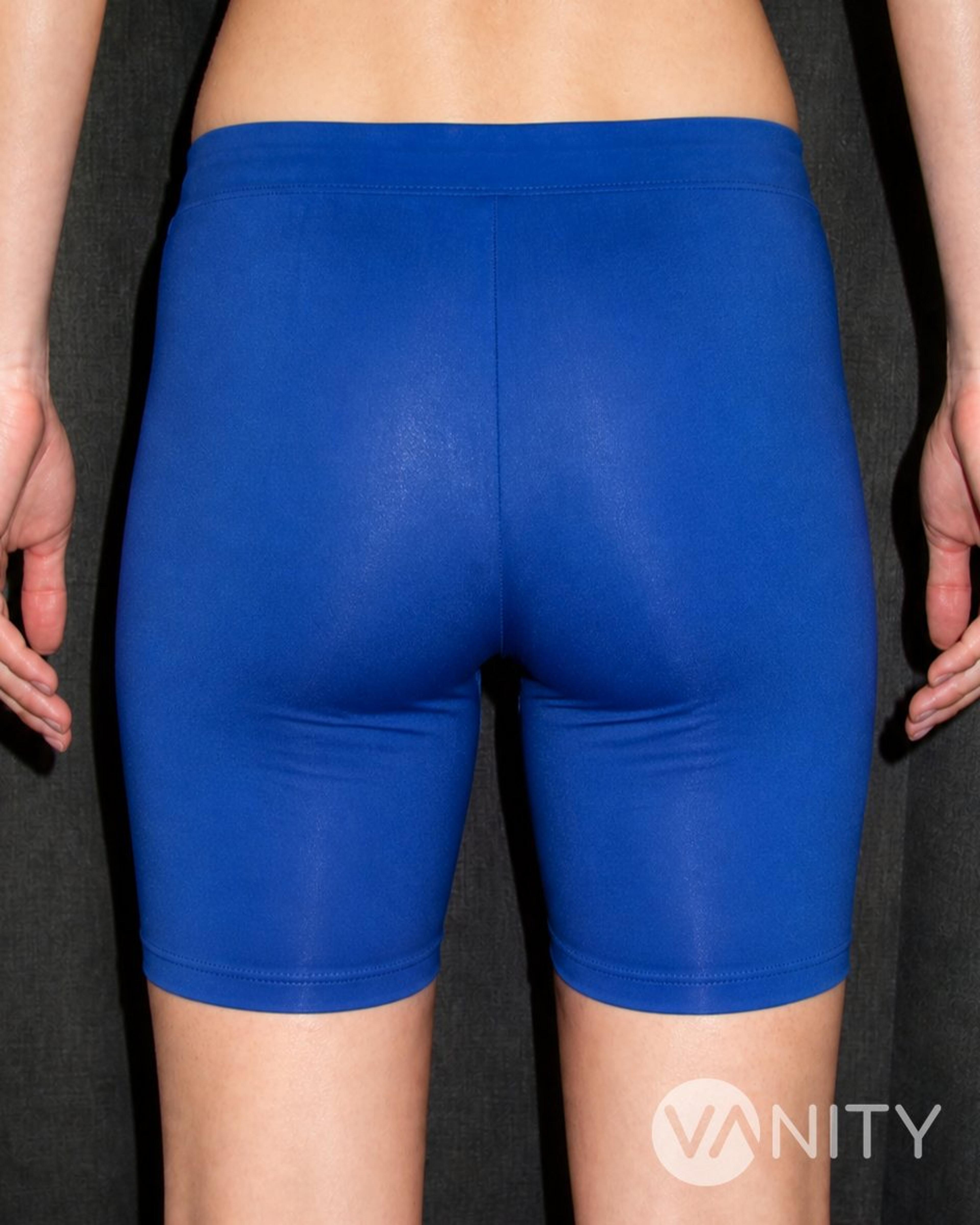 Before Buttock implants — illustrative, not a real patient