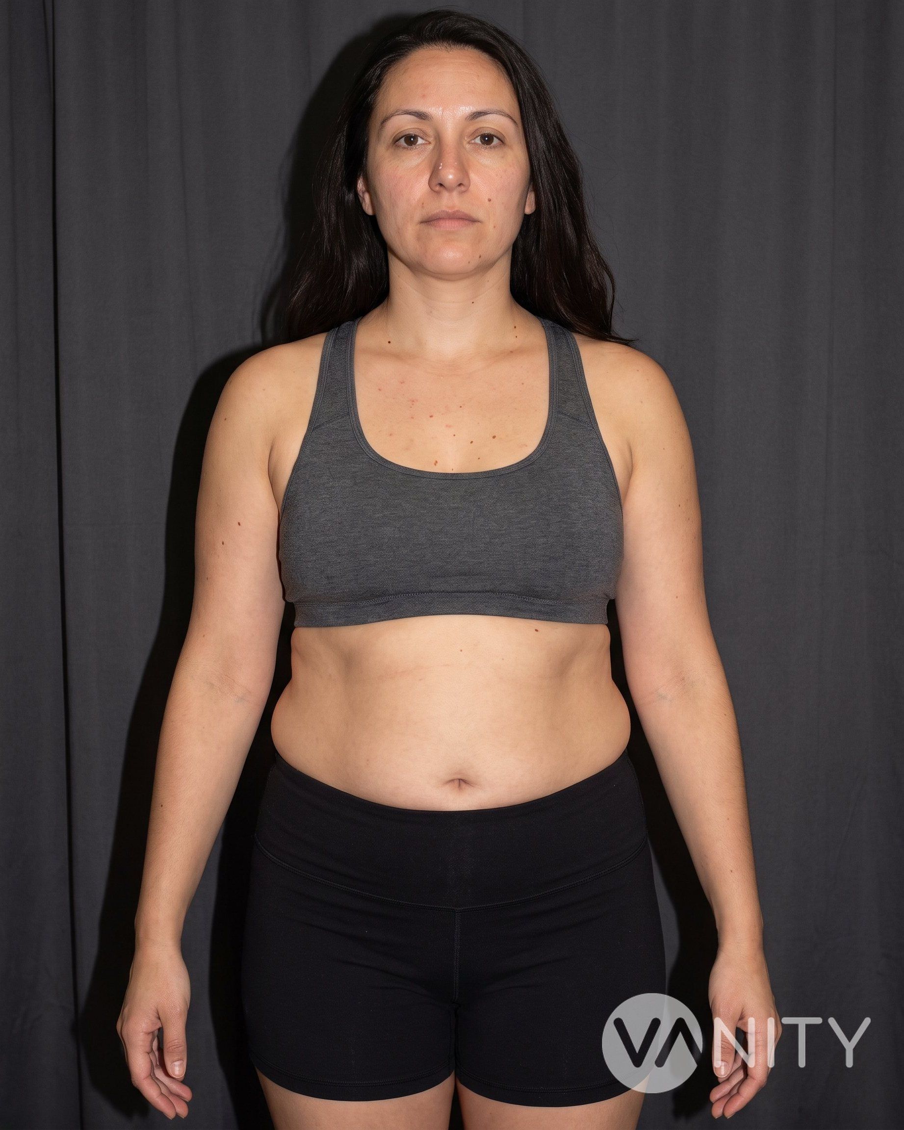 Before Liposuction — illustrative, not a real patient