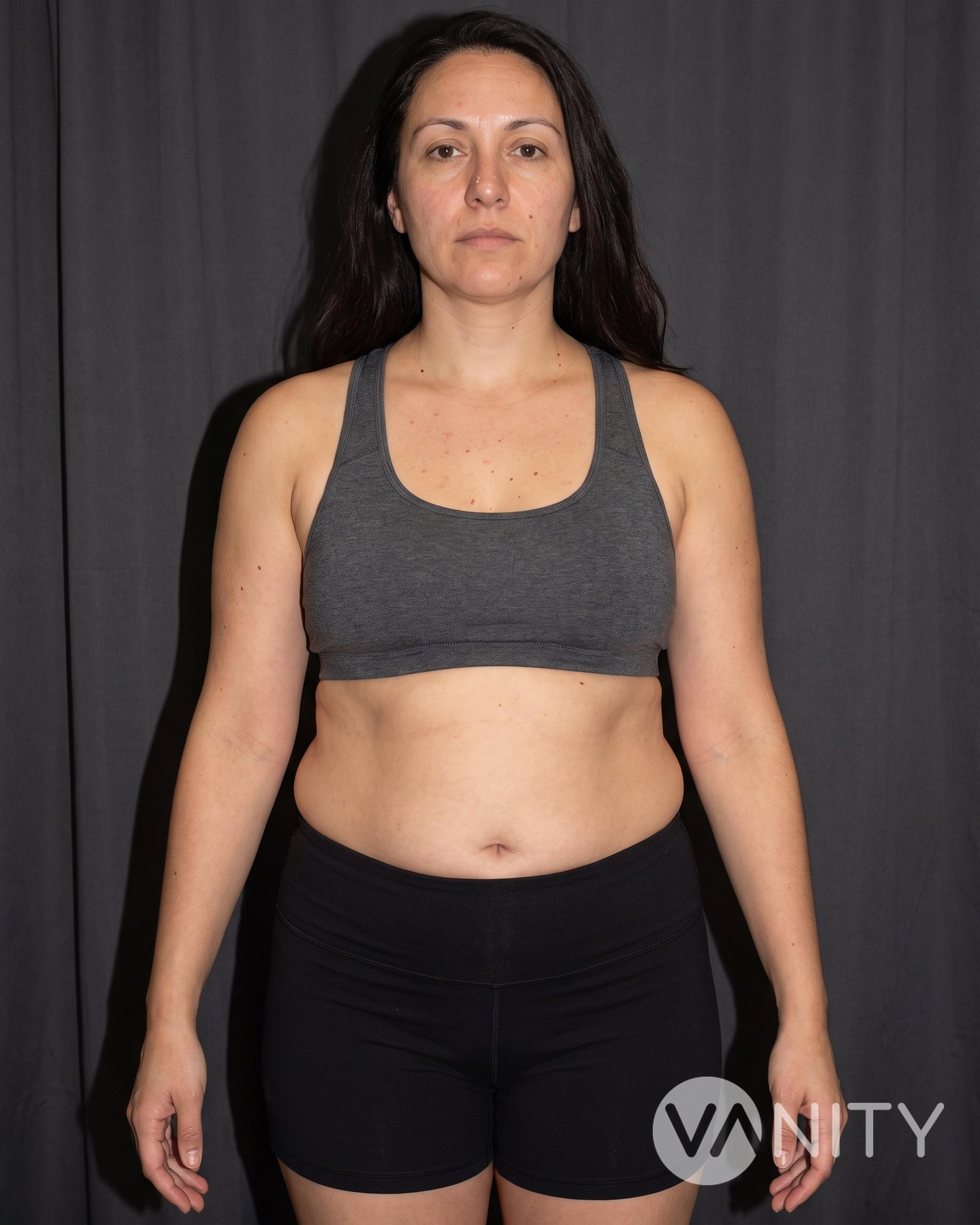 Before Liposuction — illustrative, not a real patient
