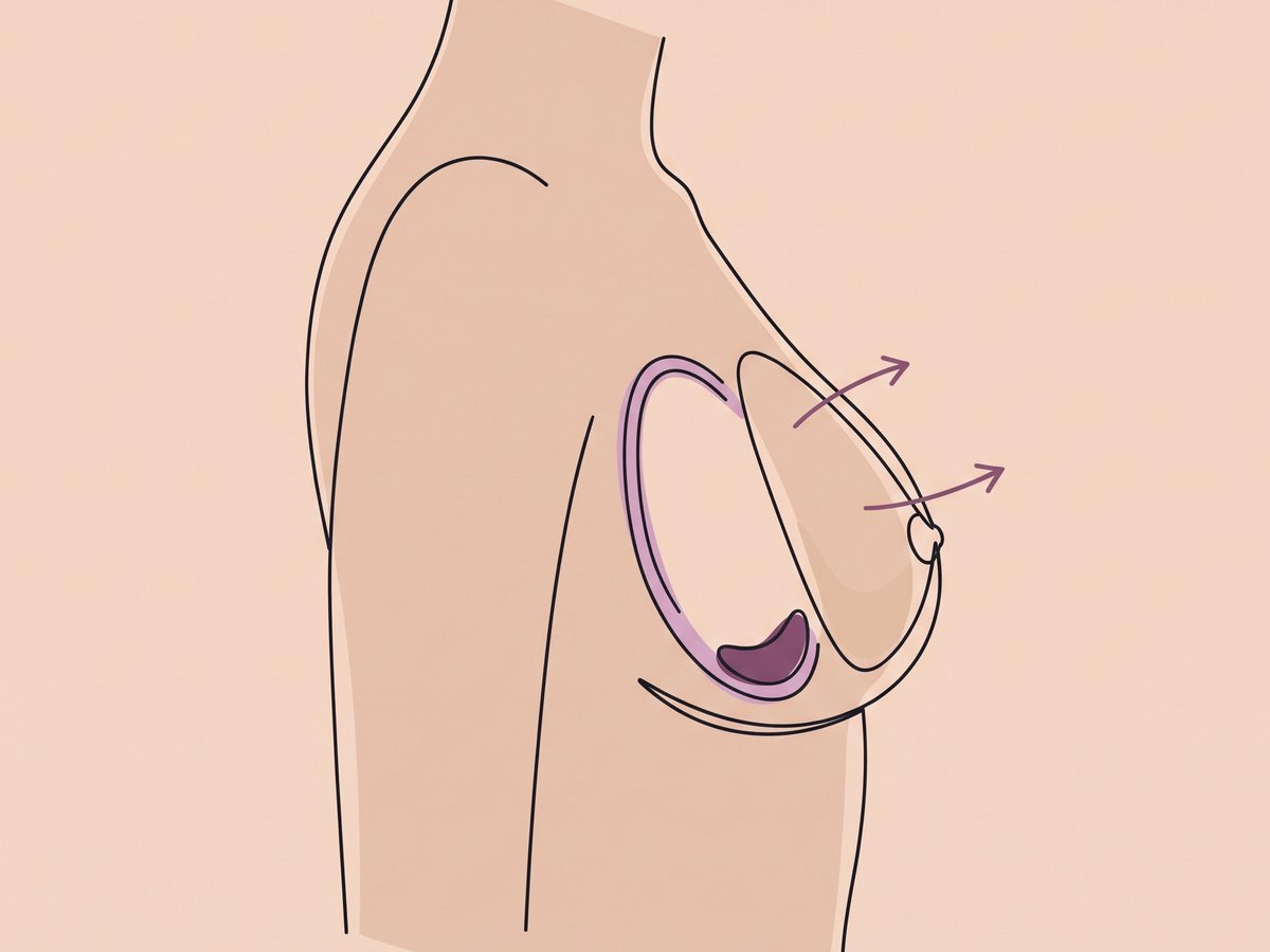 Entfernung ohne Kapsulektomie — illustration