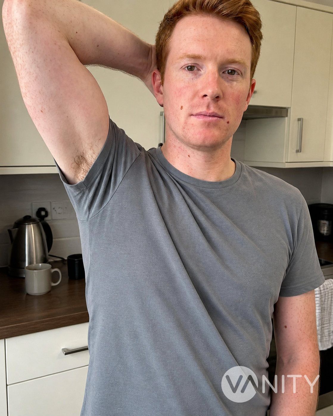 After Hyperhidrosis (excessive sweating) — illustrative, not a real patient