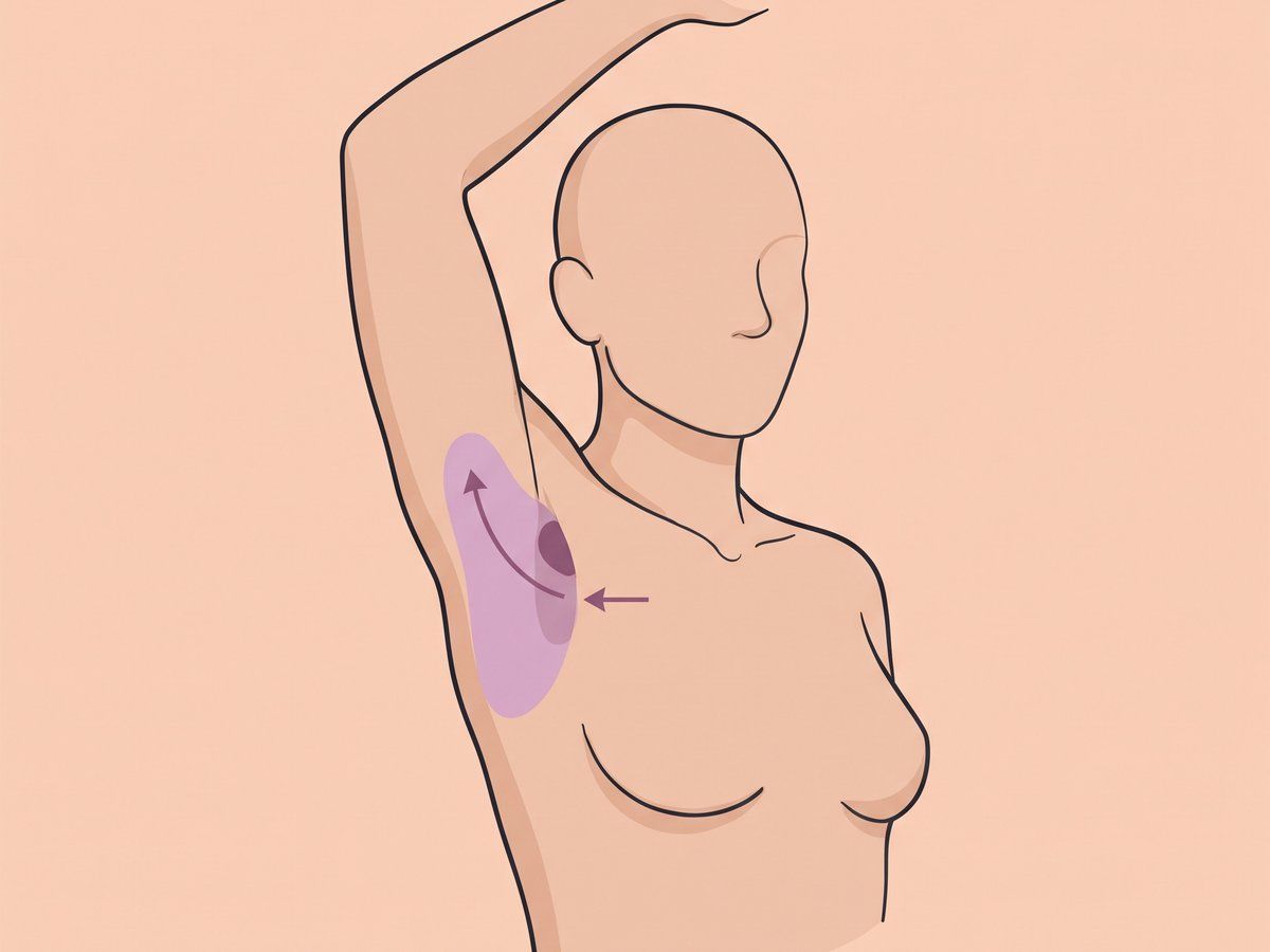 Entfernung über einen kleinen Schnitt mit Fettabsaugung — illustration