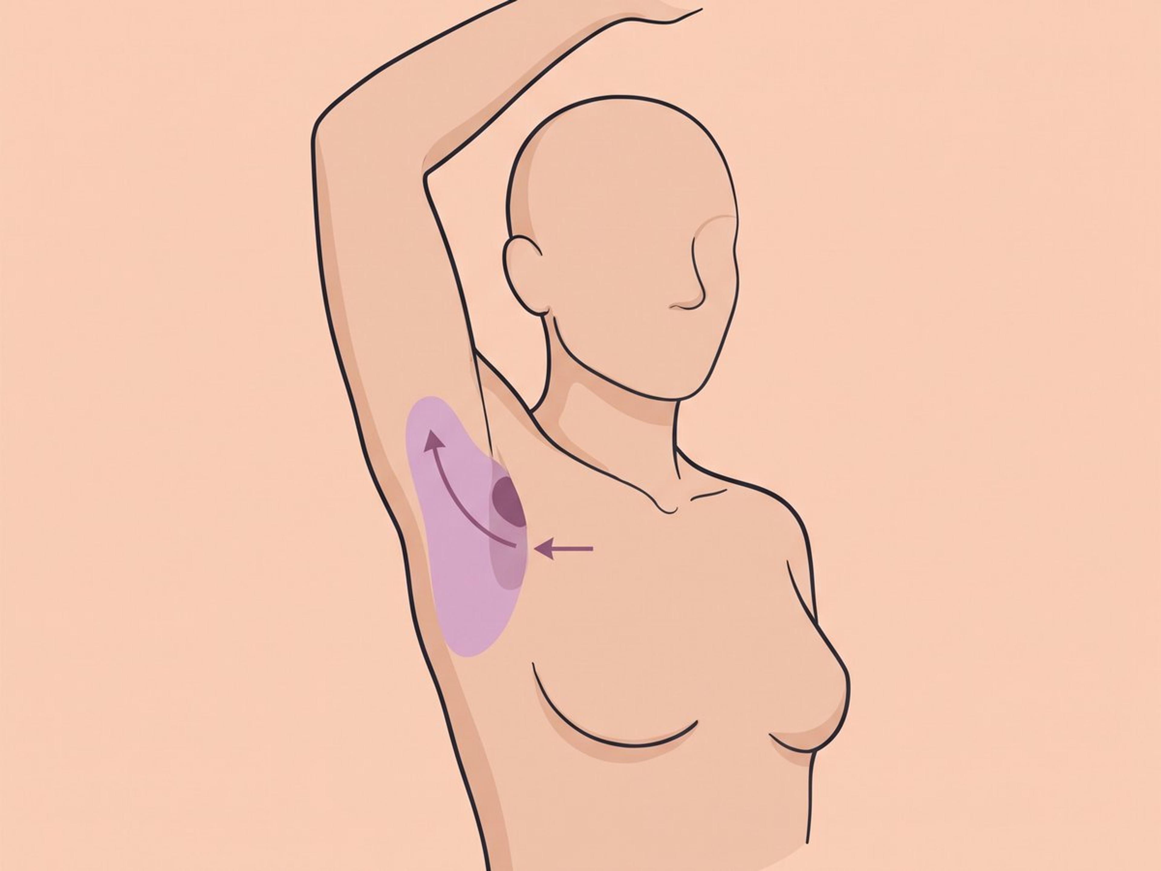Entfernung über einen kleinen Schnitt mit Fettabsaugung — illustration