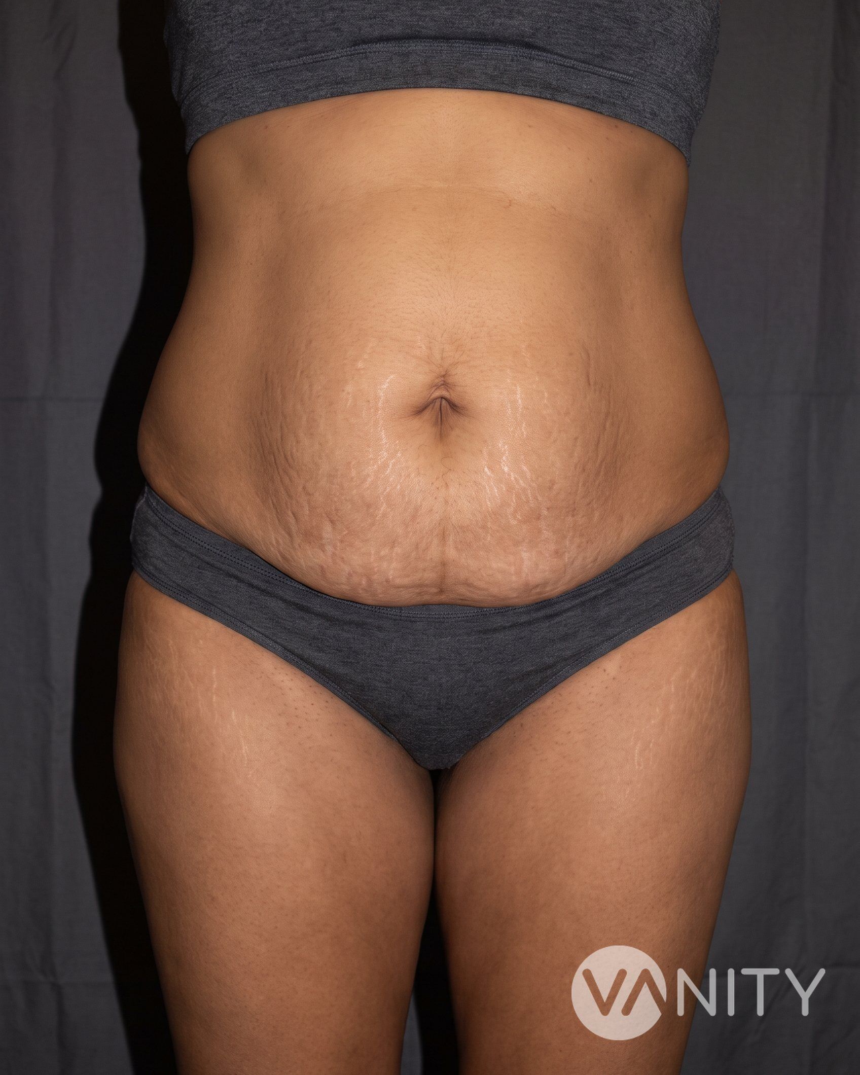 Before Tummy tuck — illustrative, not a real patient