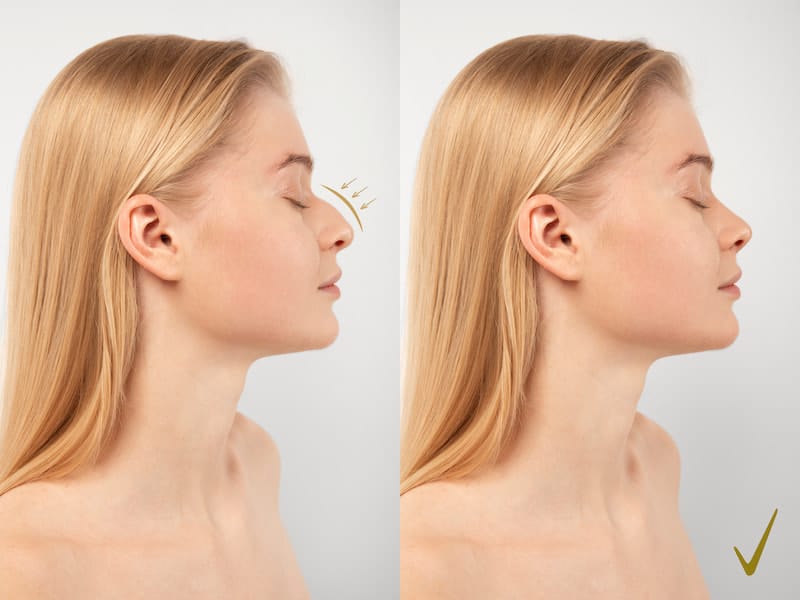 Tout ce que vous devez savoir sur la rhinoplastie en Turquie