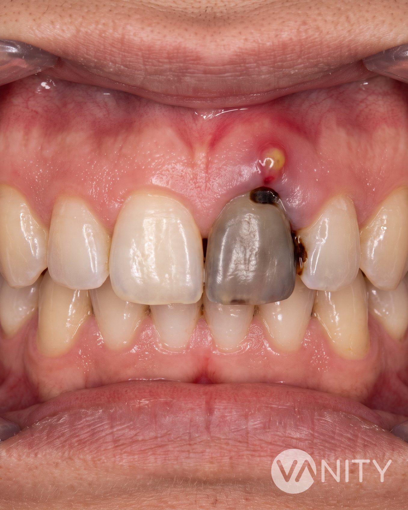 Before Root canal treatment — illustrative, not a real patient