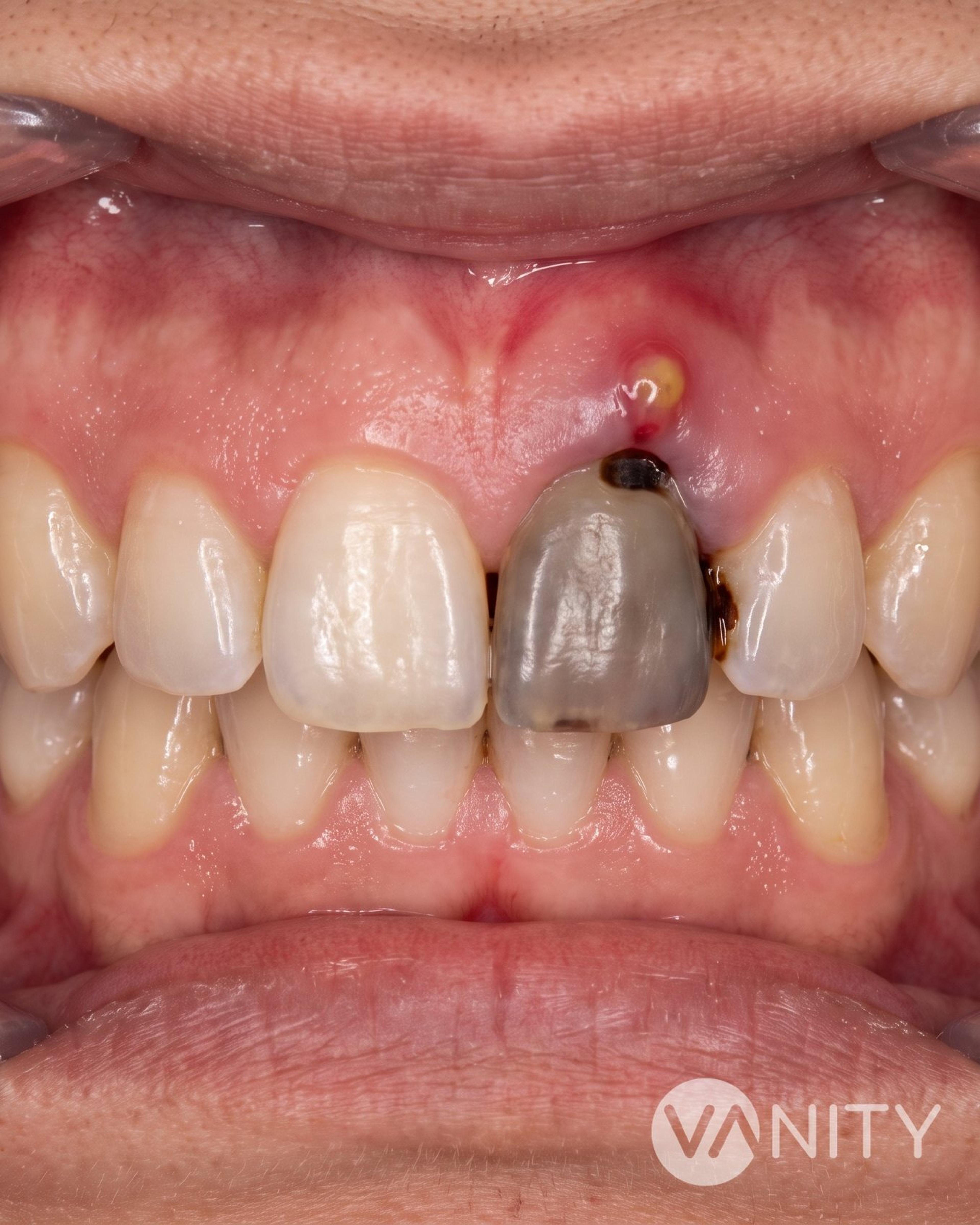 Before Root canal treatment — illustrative, not a real patient